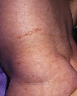 Figure 11.3, Blistering caused by the edge of a diaper in an infant with a milder form of EB.