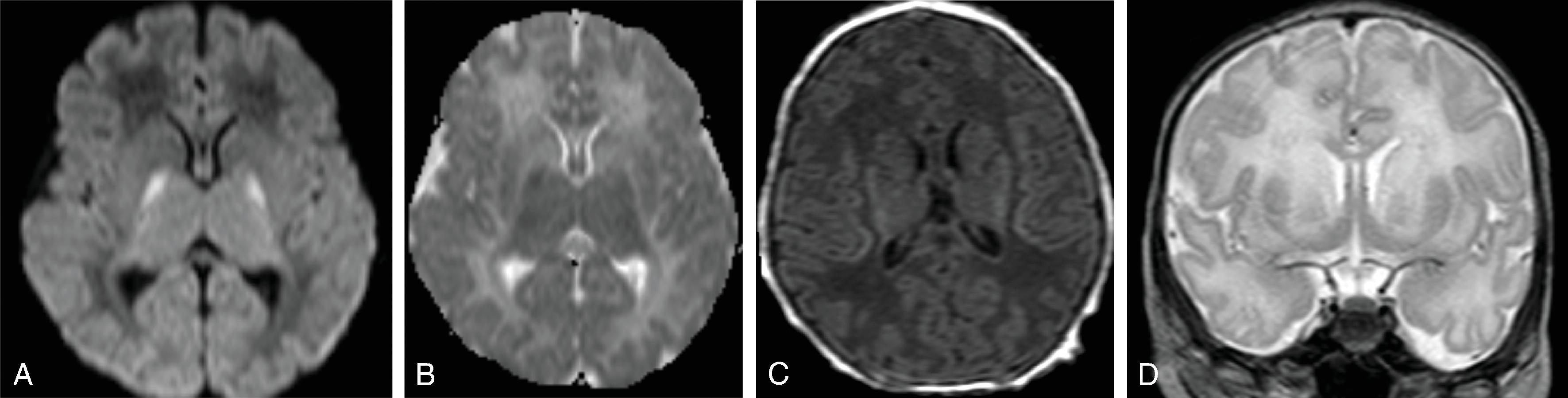 Fig. 4.10, Urea Cycle Disorder .