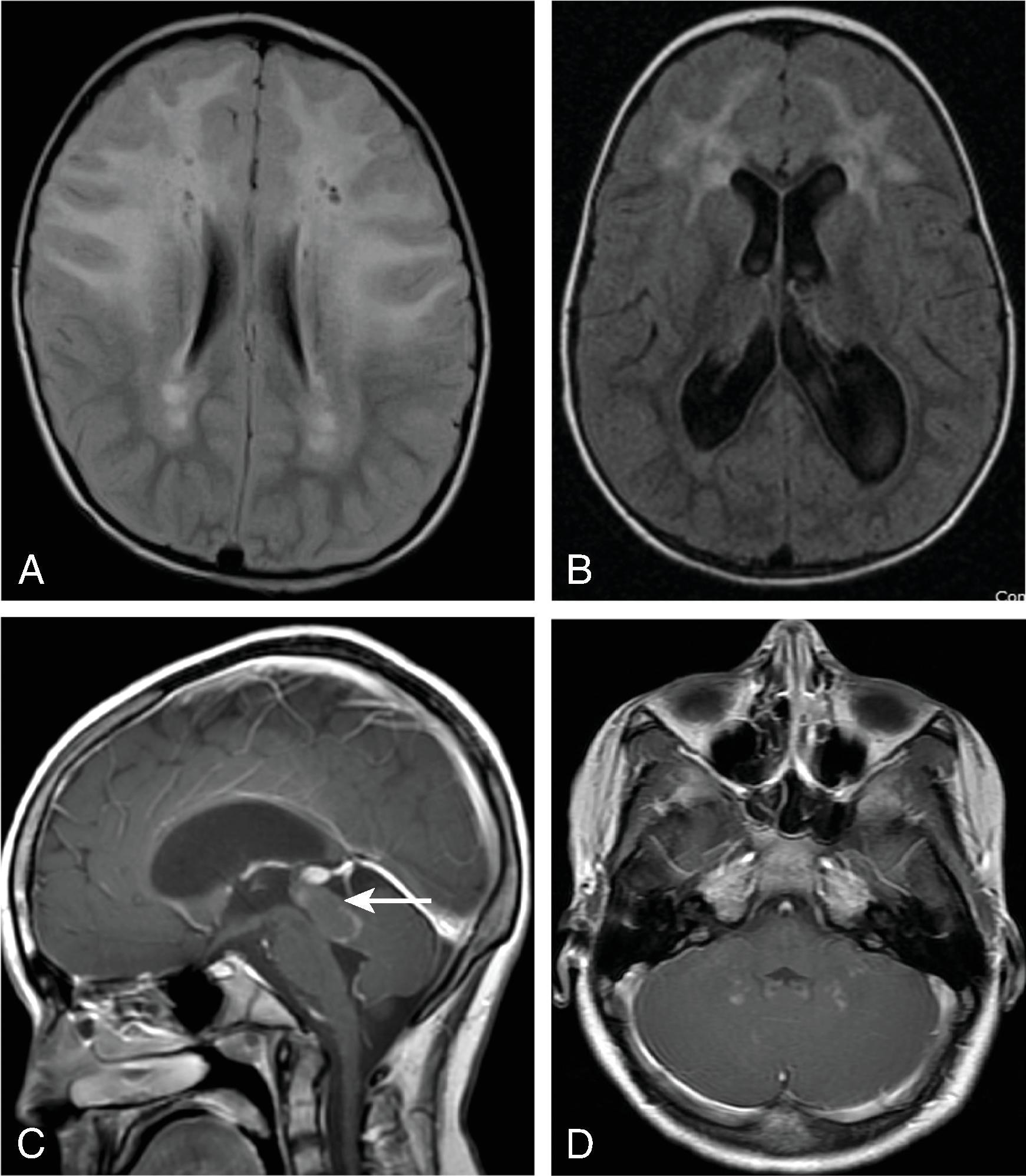 Fig. 4.12, Alexander Disease in a 12-Year-Old With Seizure .