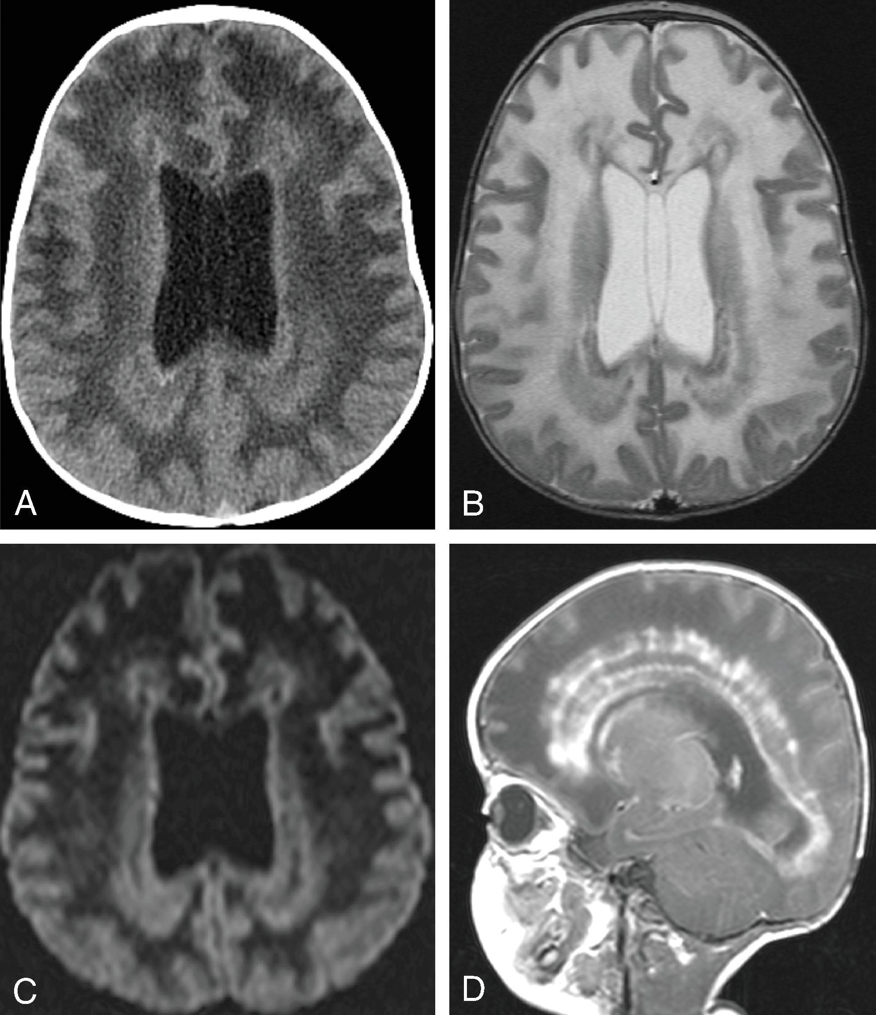 Fig. 4.13, Alexander Disease in an 8-Month-Old With Macrocephaly, Developmental Delay, and Seizures .