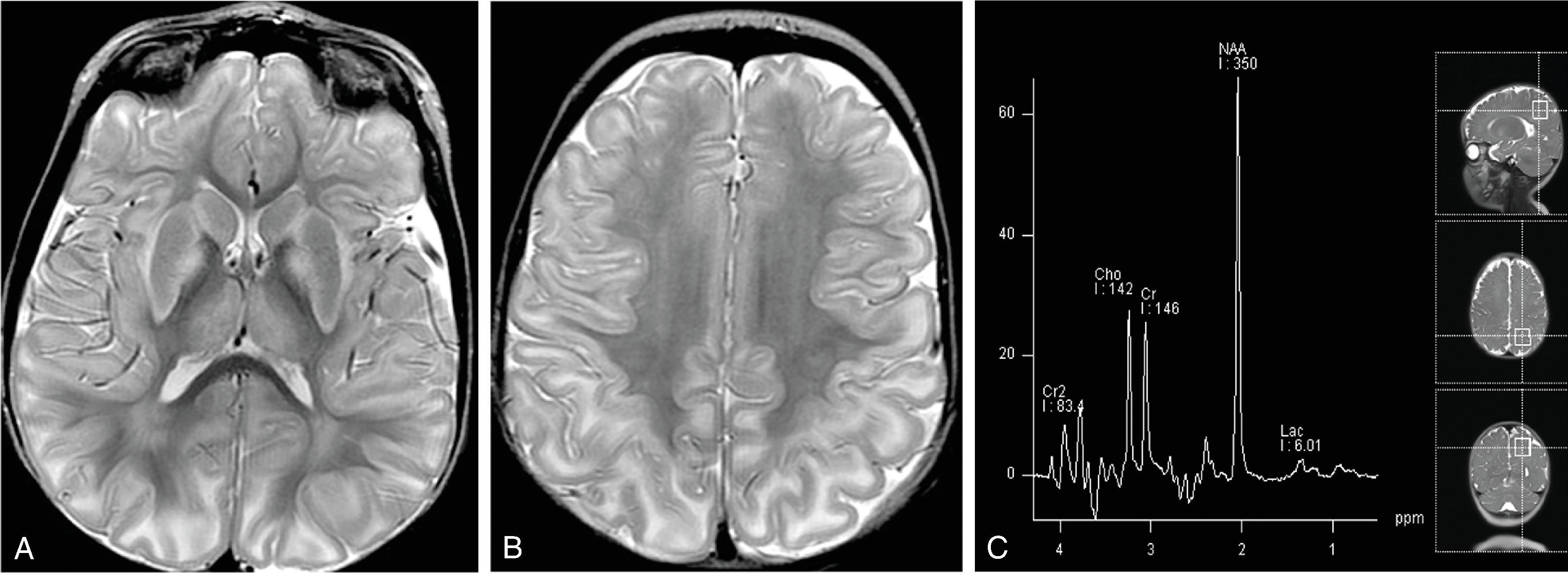 Fig. 4.15, Canavan Disease .