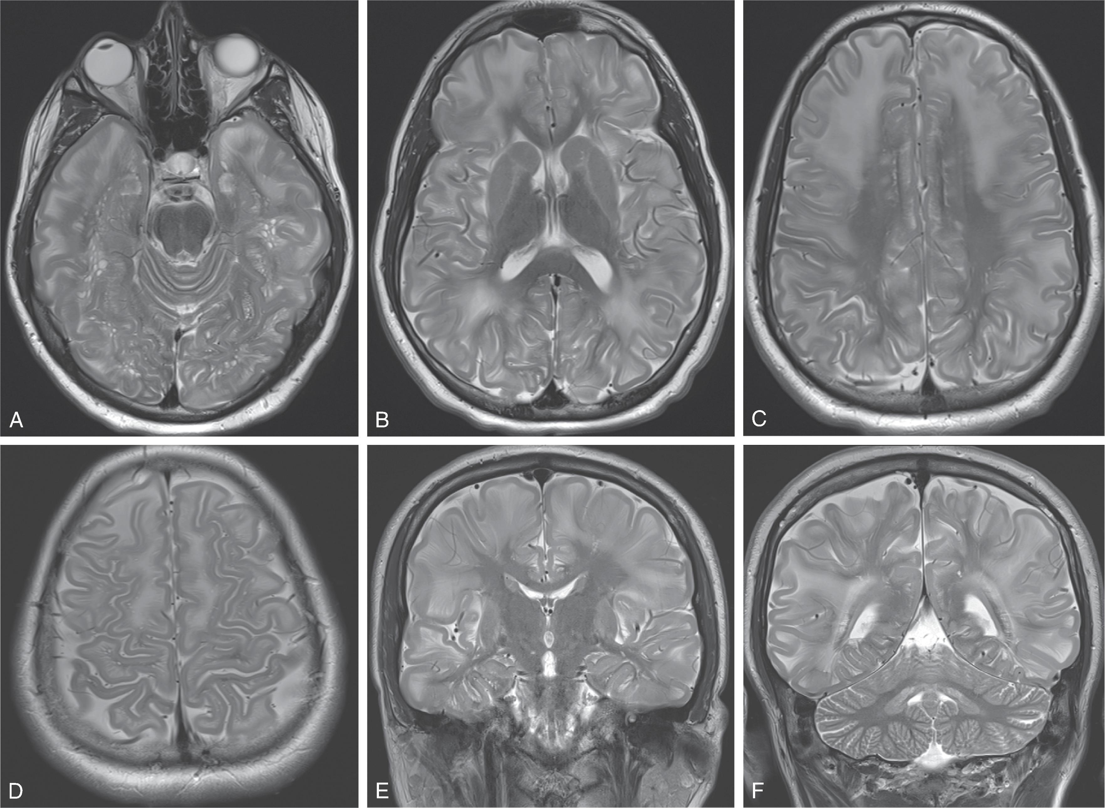 Fig. 4.16, L-2-Hydroxyglutaric Aciduria .