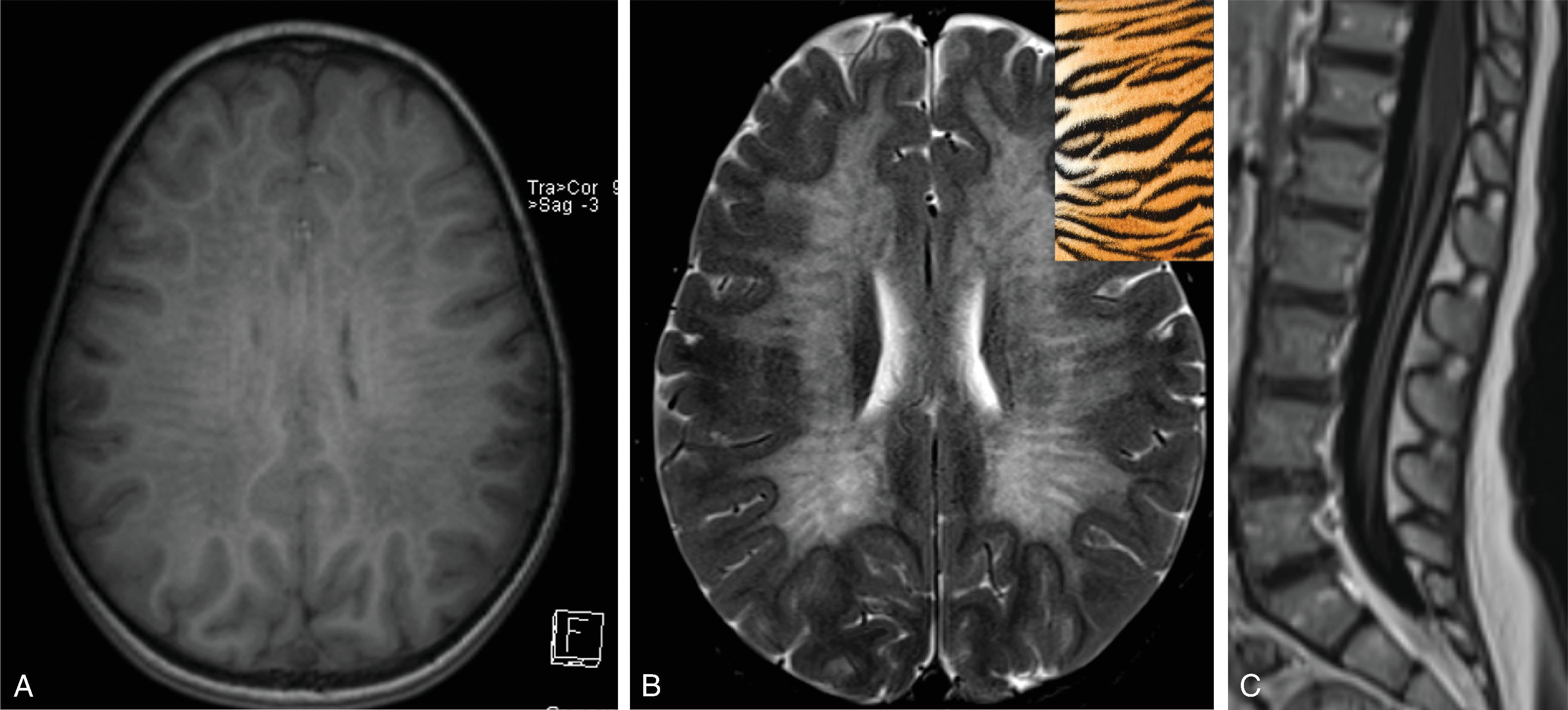 Fig. 4.17, Metachromatic Leukodystrophy .