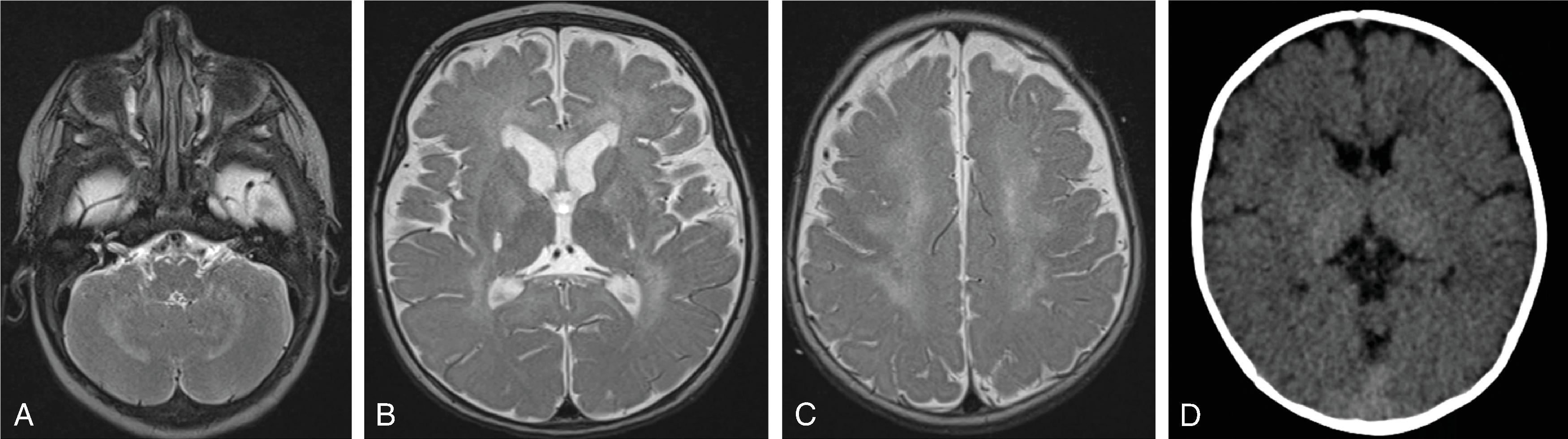 Fig. 4.19, Krabbe Disease .