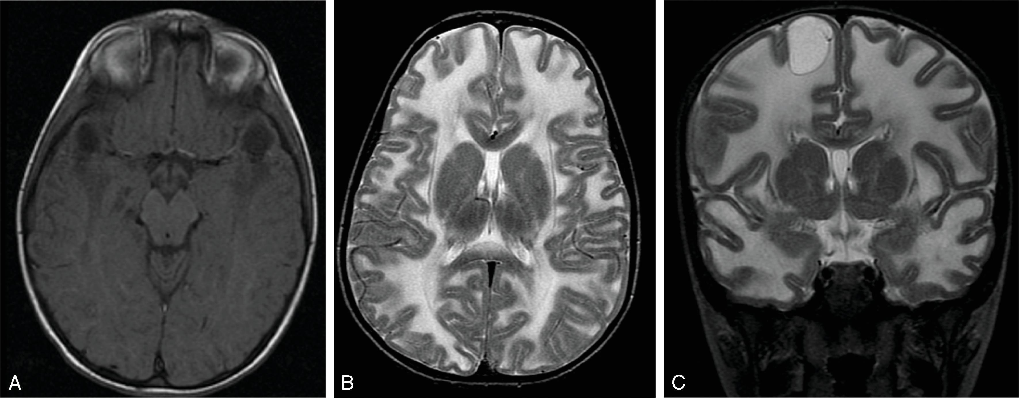 Fig. 4.21, Megalencephaly with subcortical cysts . (A) Axial T1W, and (B, C) axial and coronal T2W images demonstrates a pattern of confluent central and peripheral white matter T2W hyperintensity with anterior temporal and superior frontal cyst formation.