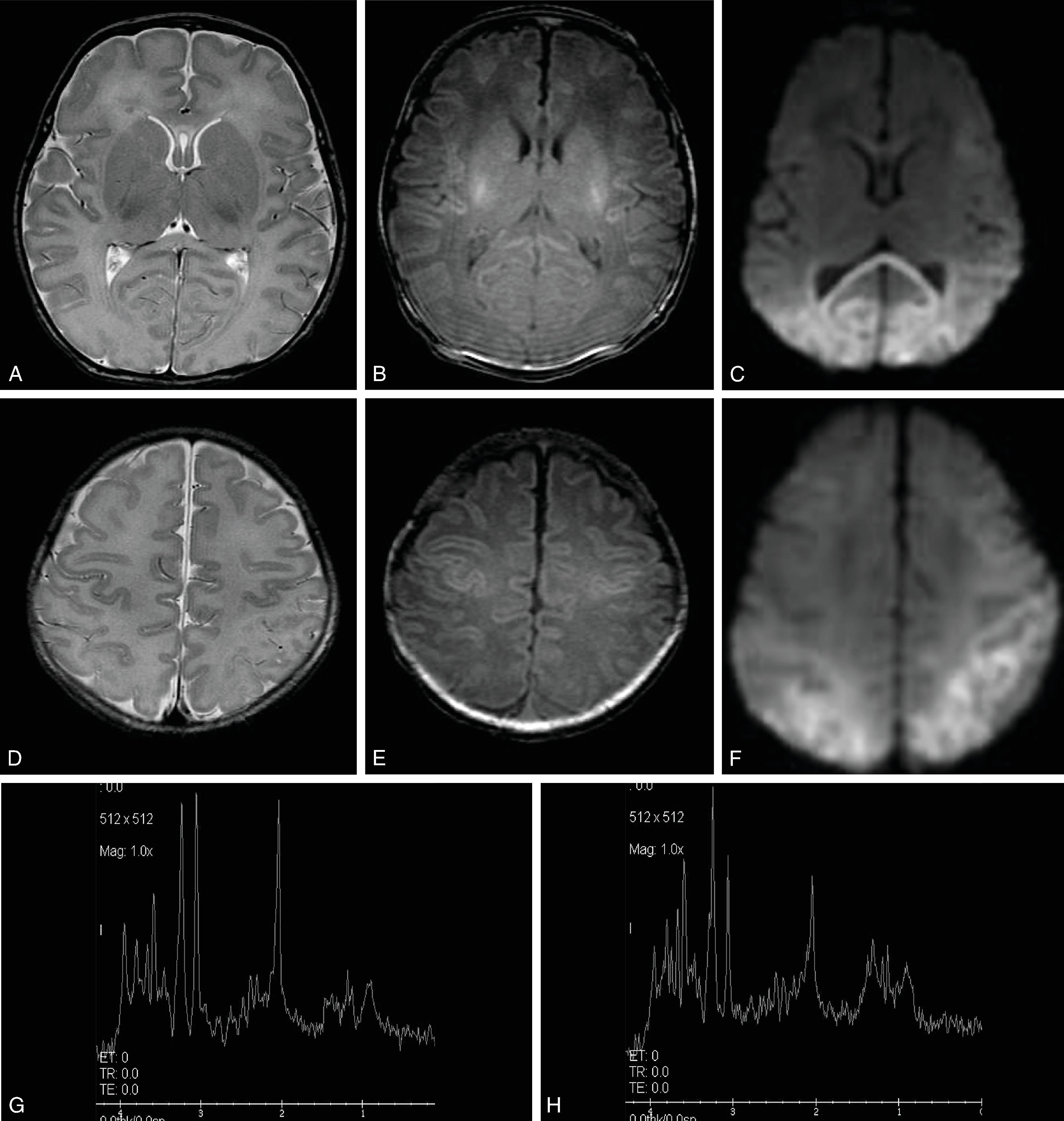 Fig. 4.3, Neonatal Hypoglycemia .