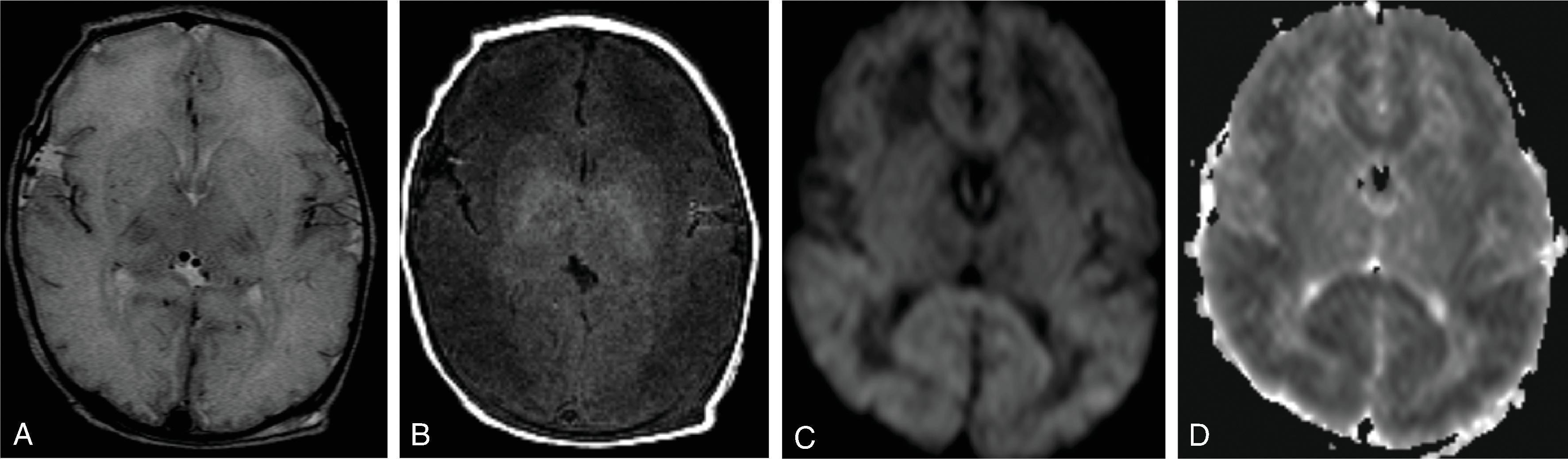 Fig. 4.6, Isolated Sulfite Oxidase Deficiency .