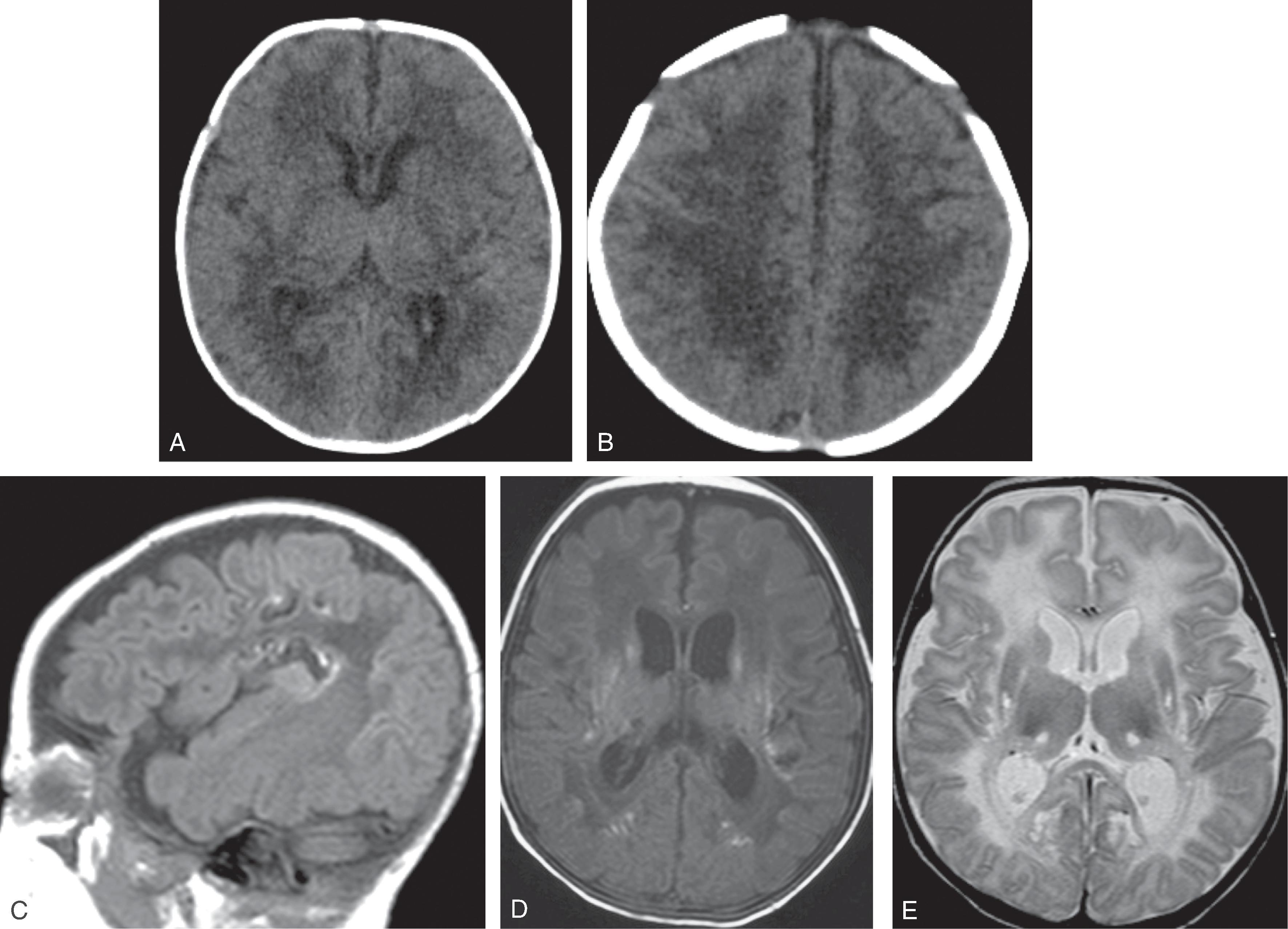 Fig. 4.9, Urea Cycle Disorder .