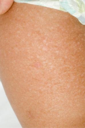 Fig. 4.13, EB simplex with mottled pigmentation: diffuse hyper- and hypopigmentation with minor small patches of erythema and occasional tiny vesicles.