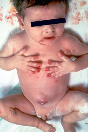 Fig. 4.14, Generalized severe junctional EB: newly born infant with blistering and nail involvement.