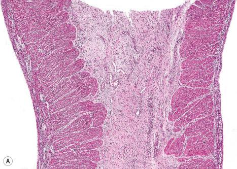 Fig. 4.17, ( A , B ) Junctional EB with pyloric atresia: pyloric canal is obliterated by fibrous connective tissue.