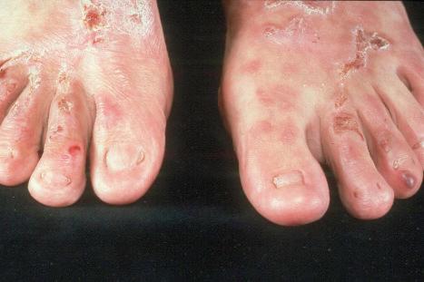 Fig. 4.19, Dominant dystrophic EB–acral: predominantly acral blisters and scarring as well as nail dystrophy.