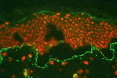 Fig. 4.5, Split skin immunofluorescence: type IV collagen lines the floor of the split skin artificial blister which therefore forms within the lamina lucida.