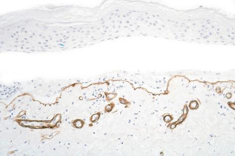 Fig. 4.7, Paraffin-embedded immunoperoxidase antigen mapping: in bullous pemphigoid, type IV collagen is present along the floor of the blister.