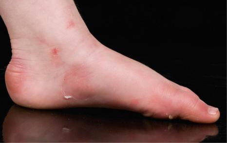 Fig. 4.11, Acral peeling skin syndrome: signs of peeling and erythema on the ankle and instep extending to the toes.