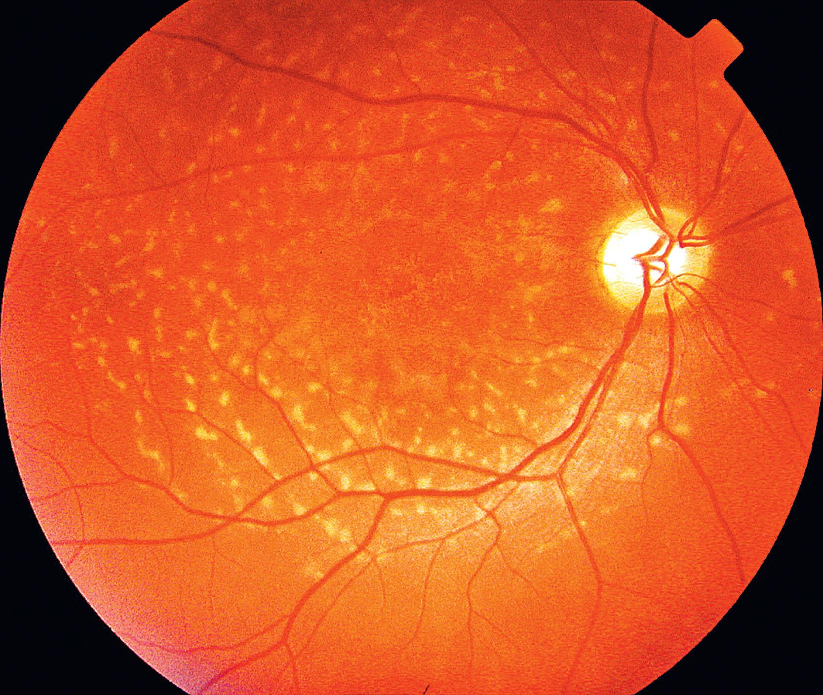 Fig. 47.1, Stargardt disease. Yellow-white flecks at the level of the retinal pigment epithelium at the posterior pole. There is early macular atrophy.