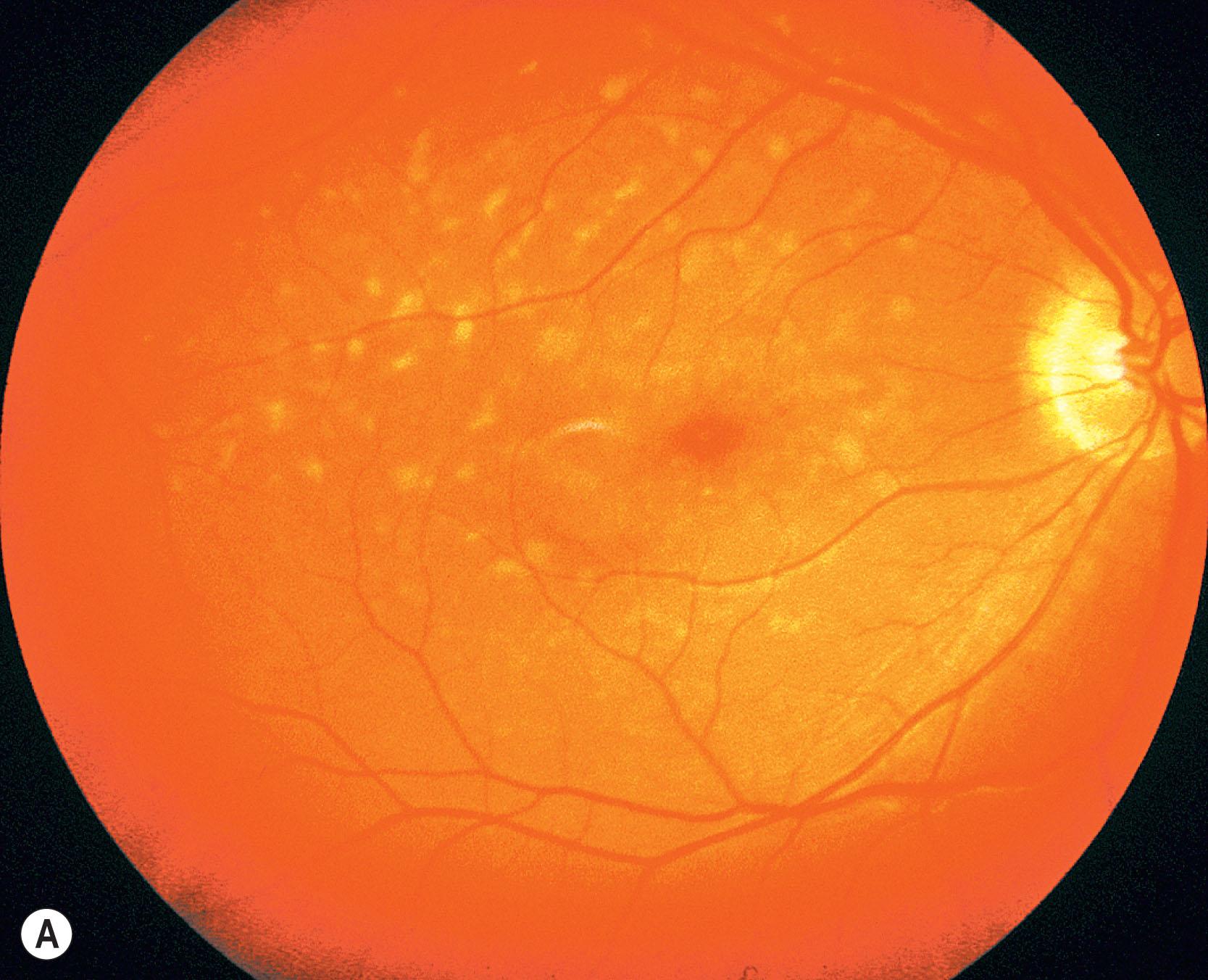 Fig. 47.2, Stargardt disease. Fluorescein angiogram (B) showing “dark choroid” and transmission defects with a color fundus photograph above (A) for comparison.