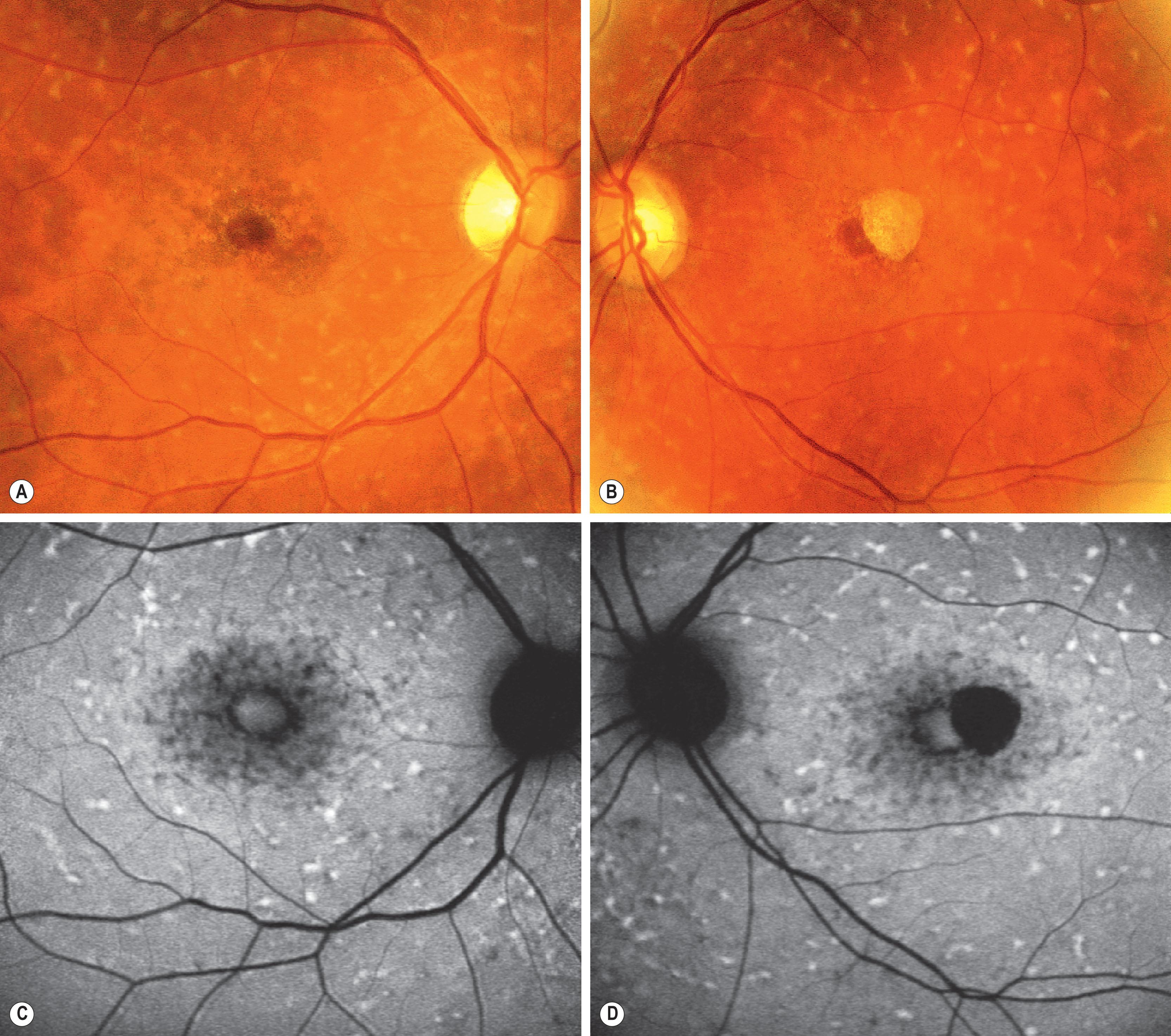 Fig. 47.3, Stargardt disease. Characteristic appearance on fundus autofluorescence imaging (C–D) showing abnormal accumulation of lipofuscin, the presence of active and resorbed flecks, and RPE atrophy; also note the peripapillary sparing. Color fundus photographs (A–B) are shown for comparison.