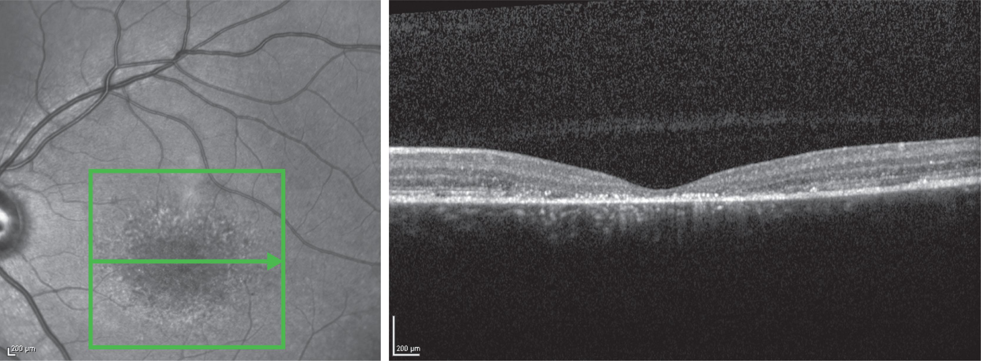 Fig. 47.4, Stargardt disease. Spectral domain optical coherence tomography (SD-OCT) showing loss of central outer retinal macular architecture with relative preservation of peripheral macular structure. Outer retinal debris can be seen at the fovea.