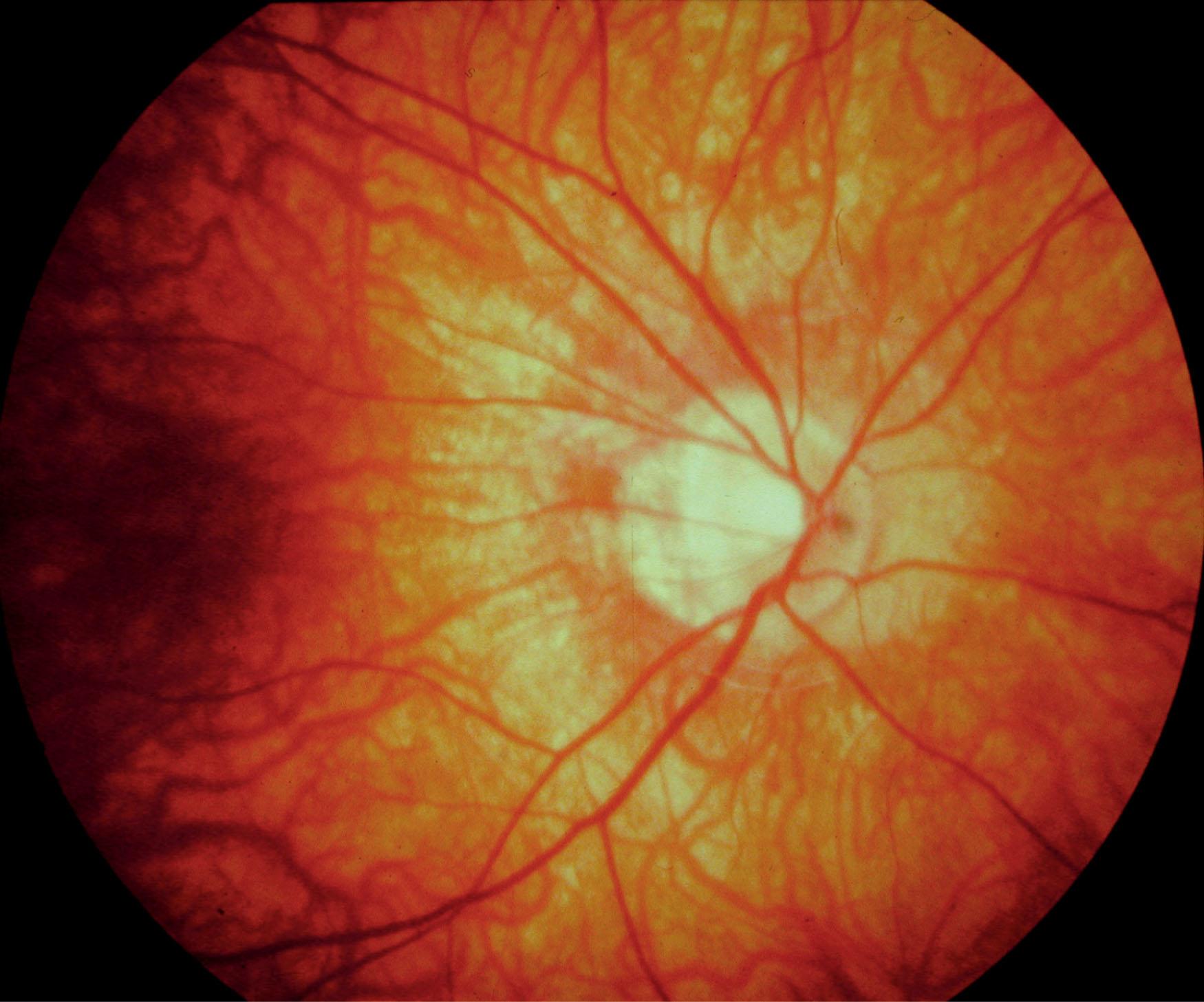 Fig. 45.1, X-linked congenital stationary night blindness. Tilted optic disc with myopic fundus.
