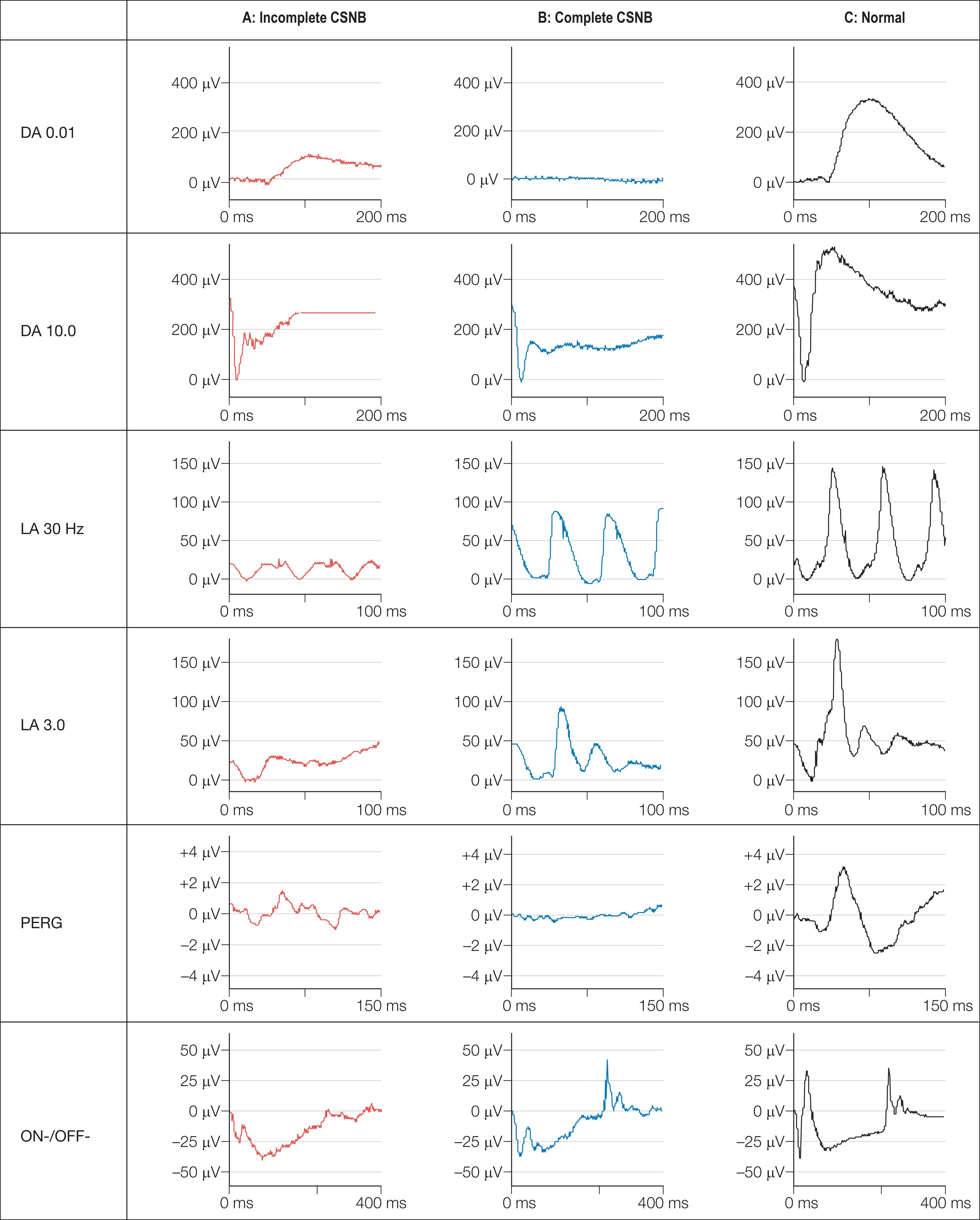 Fig. 45.2, Congenital stationary night blindness. The left-hand column traces (A) show data from a patient with “incomplete” CSNB (iCSNB); the center traces (B) are from a patient with “complete” CSNB (cCSNB); the right-hand column traces (C) are from a representative normal subject. In iCSNB the rod ERG (DA 0.01) is mildly subnormal. The bright flash response (DA 10.0) is electronegative, with a normal a-wave confirming normal photoreceptor function, but a profoundly reduced b-wave. The 30 Hz flicker ERG (LA 30 Hz) is markedly subnormal and clearly shows the delayed double peak characteristically seen in iCSNB. The photopic single flash ERG (LA 3.0) shows marked reduction in the b:a ratio with simplification of the waveform and loss of the photopic oscillatory potentials, shown on ON/OFF response recording (200 ms orange stimulus on a green background) to reflect involvement of both ON (depolarizing) and OFF (hyperpolarizing) cone bipolar cell pathways. The pattern electroretinogram (PERG) is mildly subnormal in keeping with mild macular dysfunction. In cCSNB there is no detectable DA 0.01 response and the profoundly electronegative DA 10.0 ERG confirms the site of the dysfunction to be post-phototransduction. The LA 3.0 response shows a distinctive broadened a-wave and a sharply rising b-wave with a reduced b:a ratio and lack of photopic oscillatory potentials. This appearance indicates marked dysfunction of cone ON bipolar cell pathways but preservation of the OFF pathways. The profoundly negative ON response, with preservation of the ON a-wave and loss of the ON b-wave, accompanied by a normal OFF response is confirmatory. The broadened trough of the 30 Hz flicker ERG with a sharply rising peak is a manifestation of the same phenomenon. The PERG is almost undetectable. Overall, the findings in cCSNB are those of loss of ON pathway function in both rod and cone systems.