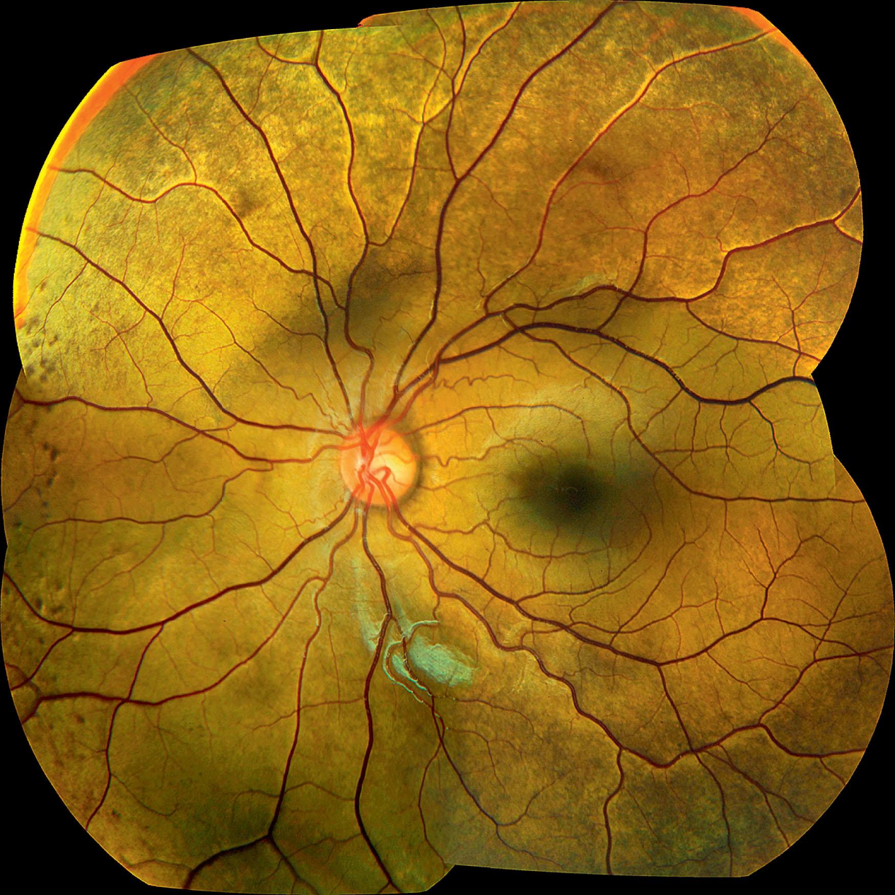 Fig. 45.3, Oguchi disease. Grayish or green–yellow discoloration of the fundus, which reverts to normal on prolonged dark adaptation (Mizuo phenomenon).