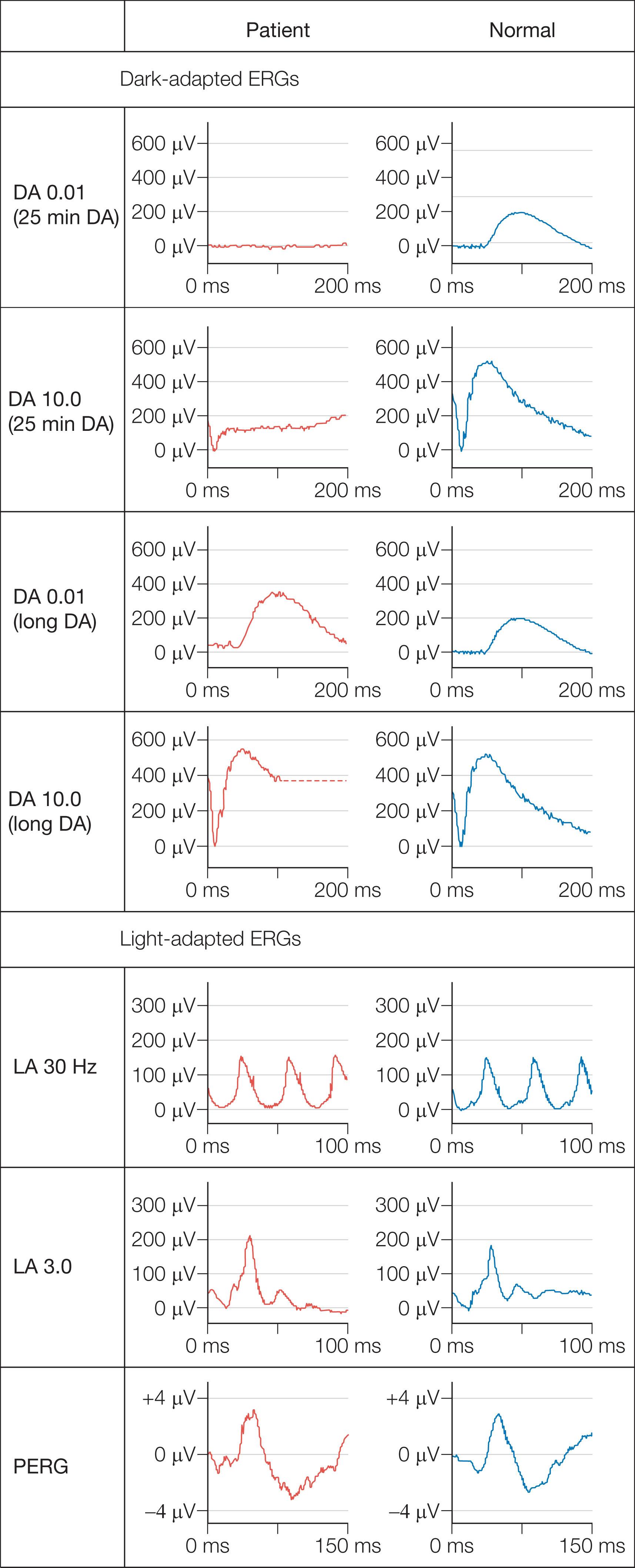 Fig. 45.4, Fundus albipunctatus. The DA 0.01 electroretinogram (ERG) is undetectable following a standard period of dark adaptation and the DA 10.0 response is reduced with additional reduction in the b:a ratio, in keeping with an origin in dark-adapted cones. Following an extended period of dark adaptation, both DA 0.01 and DA 10.0 responses are completely normal in keeping with delayed restoration of normal levels of rhodopsin.