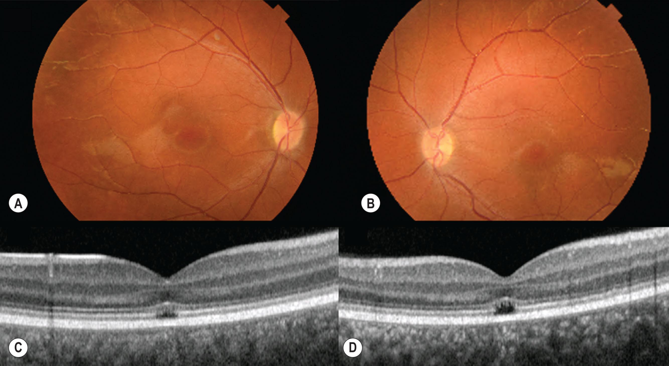 Fig. 45.5, A 13-year-old female with CNGB3-achromatopsia. (A–B) Color fundus photographs demonstrating normal retinal appearances bilaterally. (C–D) Optical coherence tomography (OCT) scans showing disruption of the foveal ellipsoid zone (EZ) bilaterally with focal hyporeflective area.