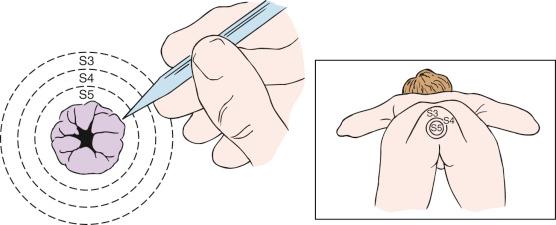 Fig. 11.6, Test sensation in the lower sacral dermatomes to evaluate for sacral sparing.