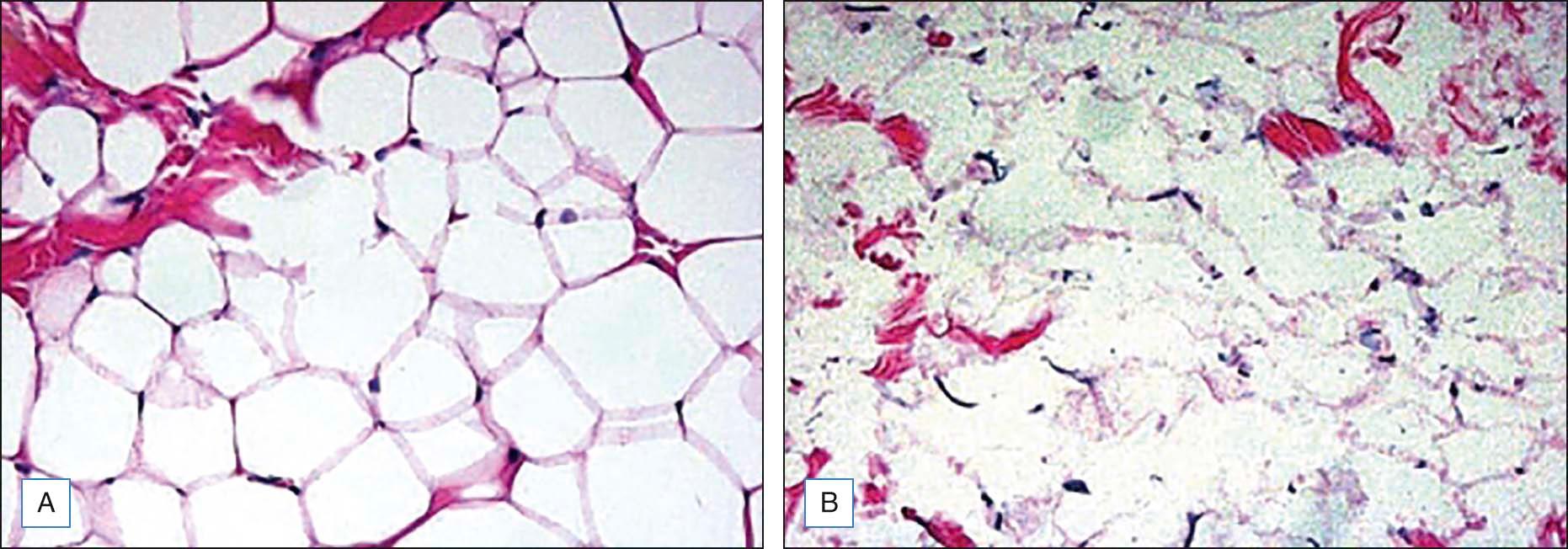 Figure 11.2, Deoxycholate ex vivo histology. Light microscopy of porcine skin biopsies revealing (A) control adipocytes and (B) adipocytes after deoxycholate injection (hematoxylin and eosin, original magnification ×20)