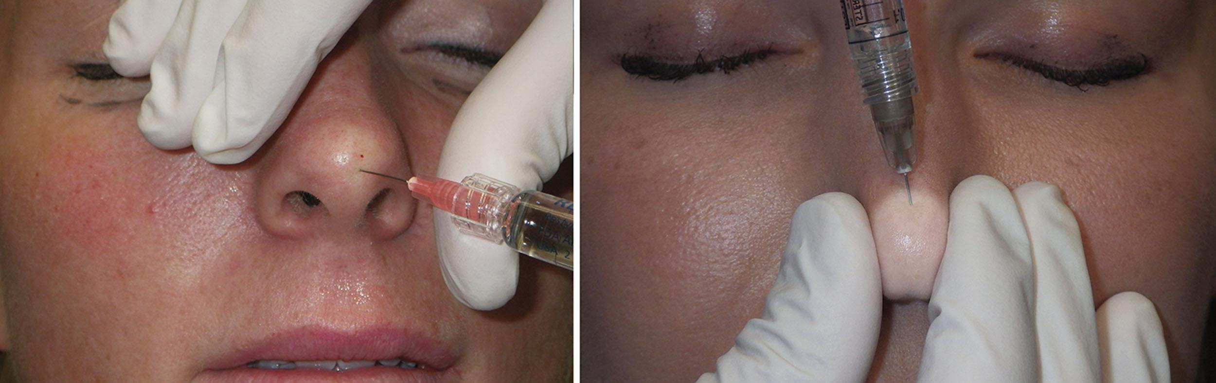 Fig. 10.101, Injecting deep in the nasal tip can produce recontouring. The nasal tip can be a dangerous injection site, and tissue loss and disfigurement are well documented.