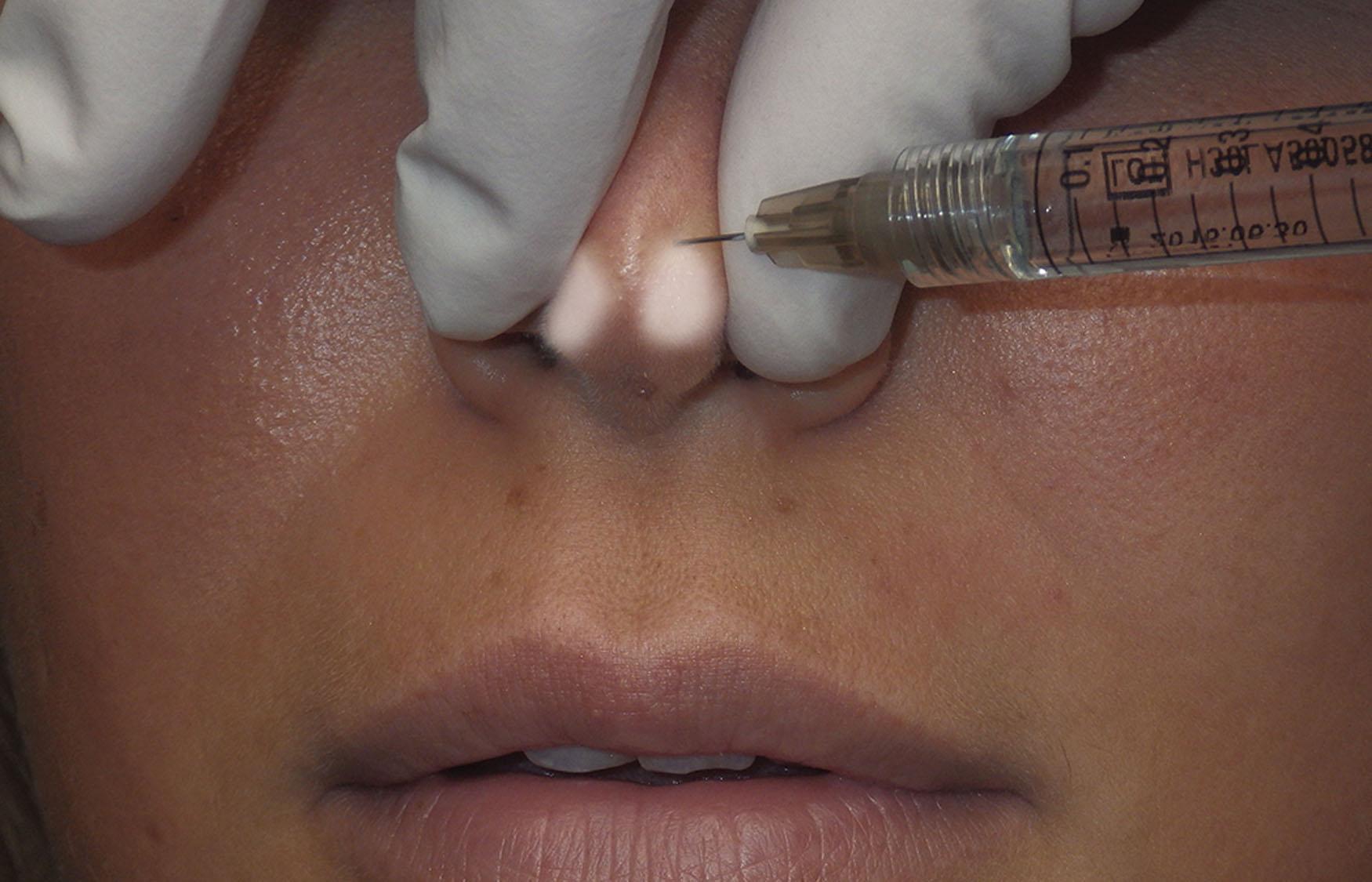 Fig. 10.103, Nasal tip corrections can be performed with small amounts of injectable filler.