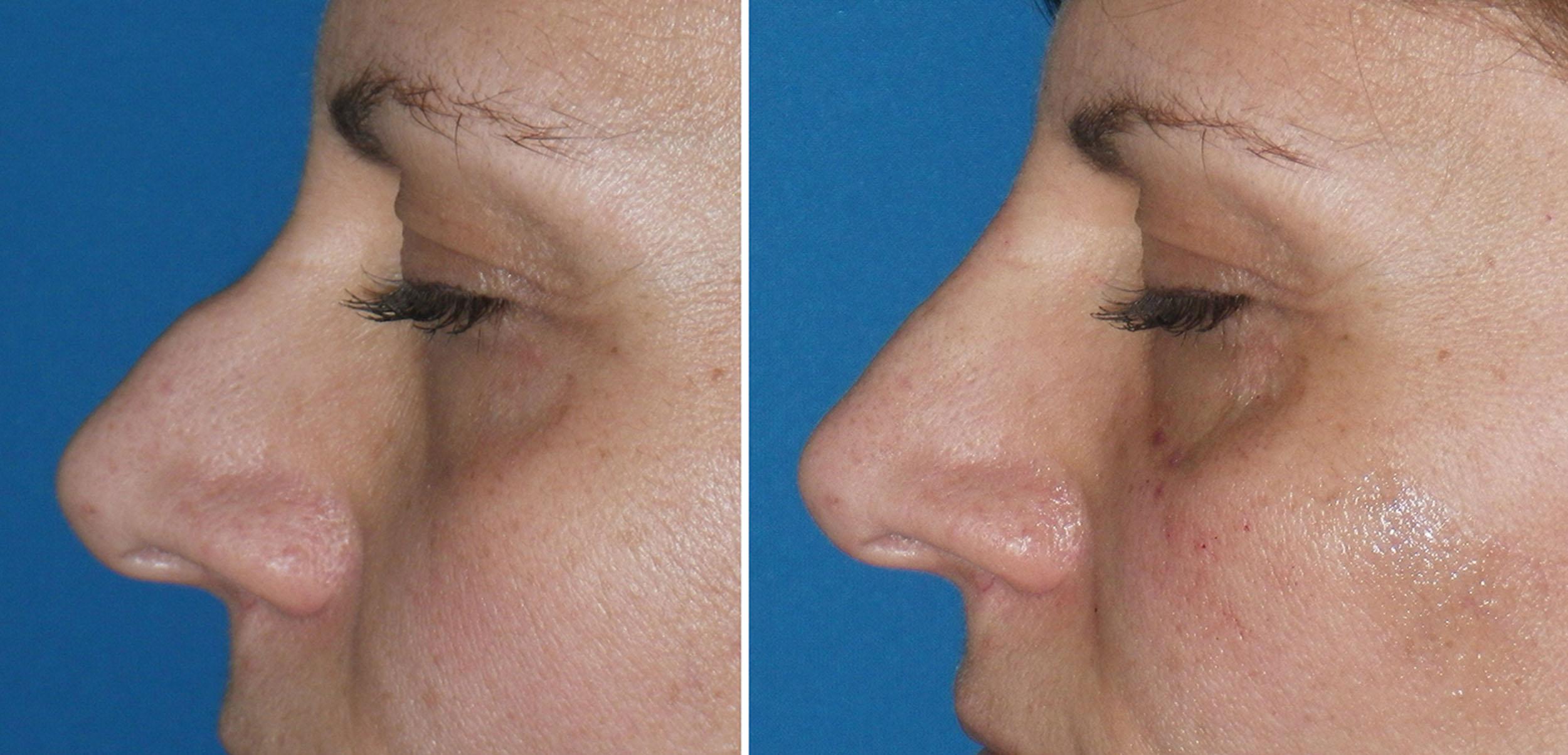 Fig. 10.104, This patient is shown before (left) and after (right) filler rhinoplasty using 1 mL of hyaluronic acid filler.