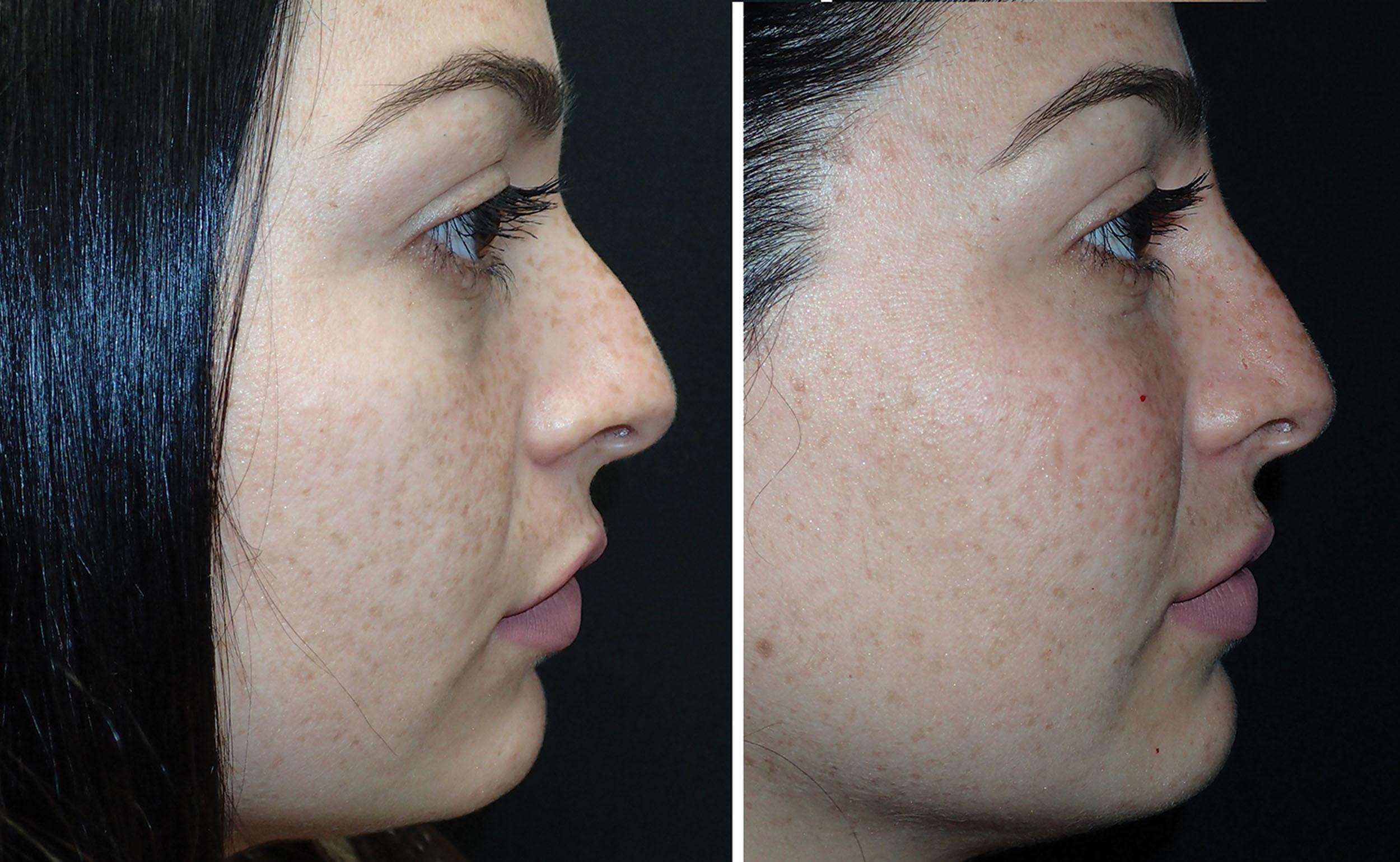 Fig. 10.105, This patient presented with a small dorsal nasal hump (left) , which was improved with 1 mL of hyaluronic acid filler. Sometimes these patients are elated with these small changes that can improve an insecurity that they have had for years without surgery.