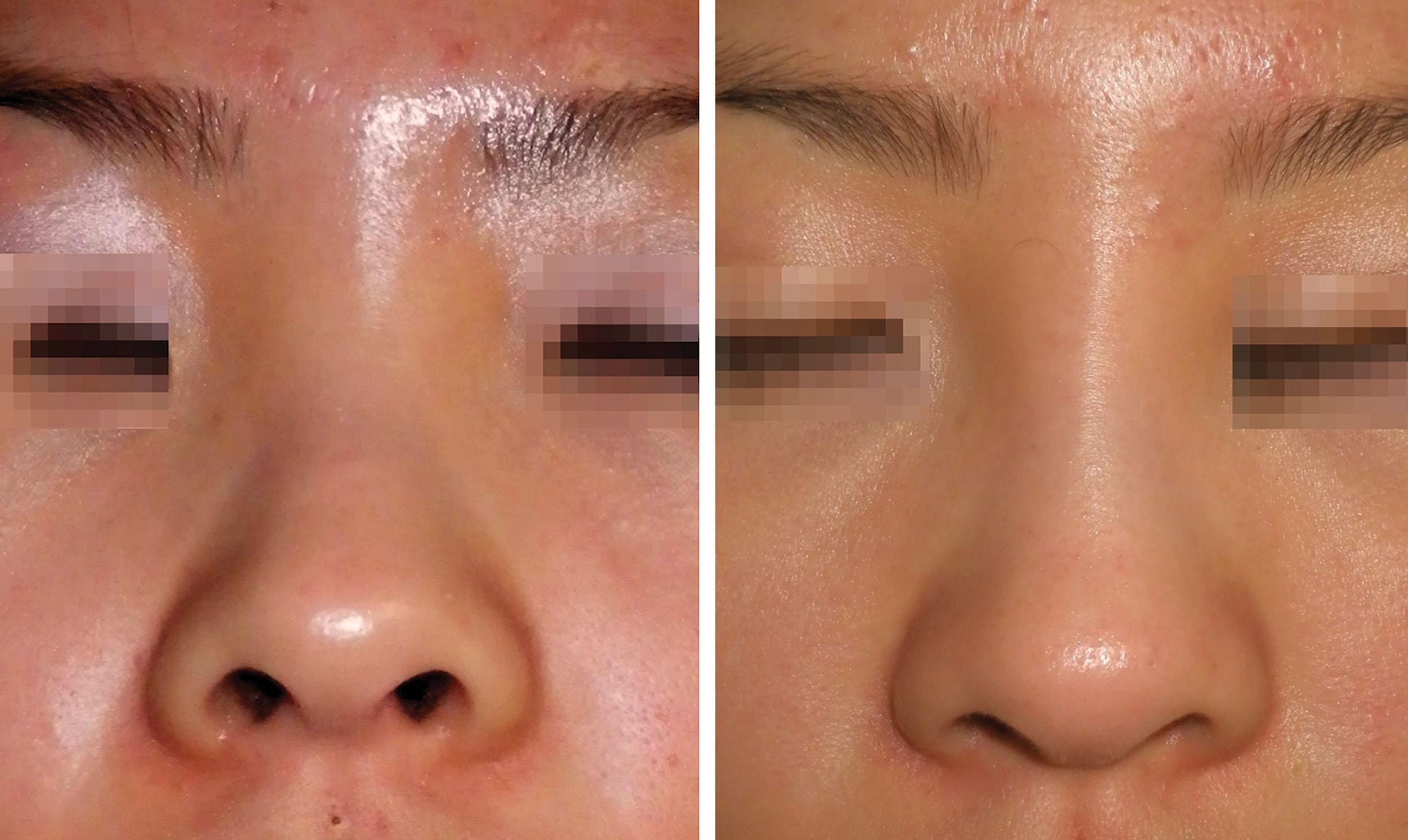Fig. 10.106, This Asian patient was treated with 1.5 mL of hyaluronic acid filler over two appointments. The patient had a very depressed and almost absent nasal bridge, which was recontoured to a more aesthetic architecture.