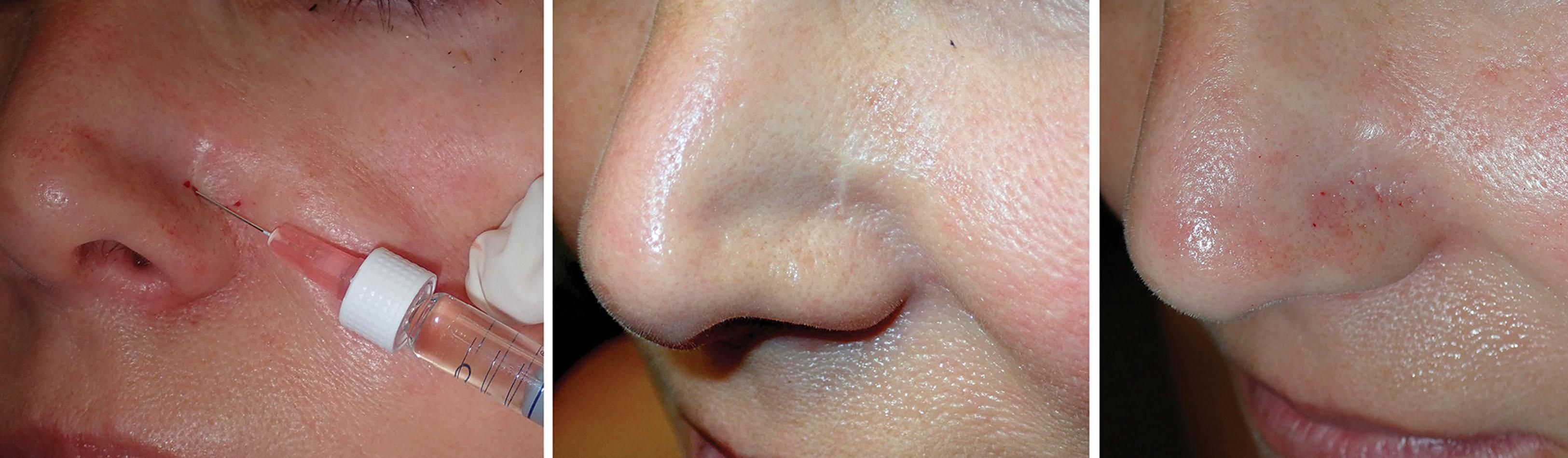 Fig. 10.108, This patient presented with an indentation from lateral nasal collapse after previous rhinoplasty at another office. The method of superficial injection is shown (left). The before photo (center) and after photo (right) show the improved area immediately after injection with approximately 0.5 mL of hyaluronic acid filler.