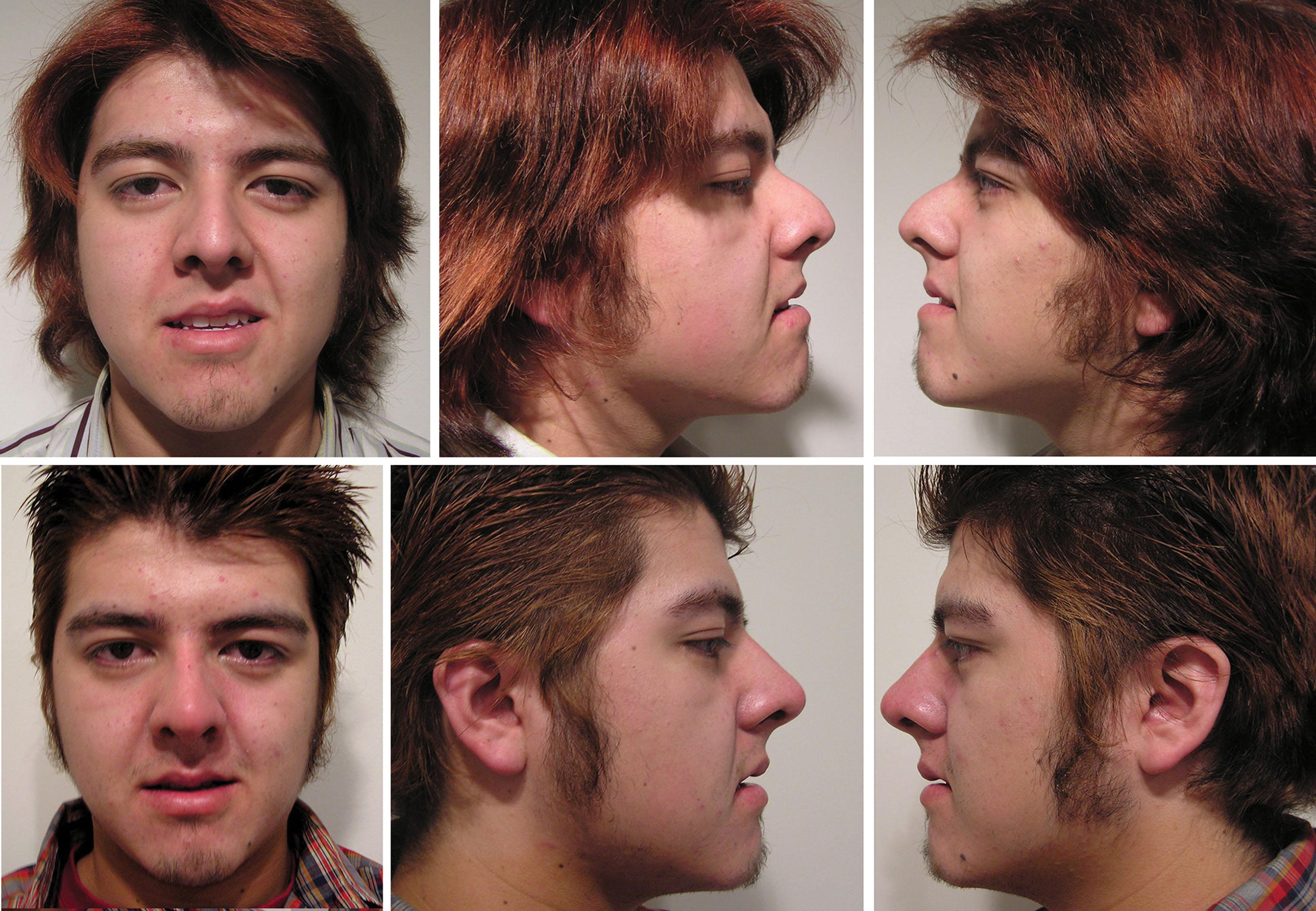 Fig. 10.109, This patient underwent nonsurgical rhinoplasty to lift a ptotic nasal tip and augment the nasal radix. Before photos (top) and after photos (bottom) are shown. The net result is a straighter nose on profile that appears smaller because it blends better with the rest of the face.