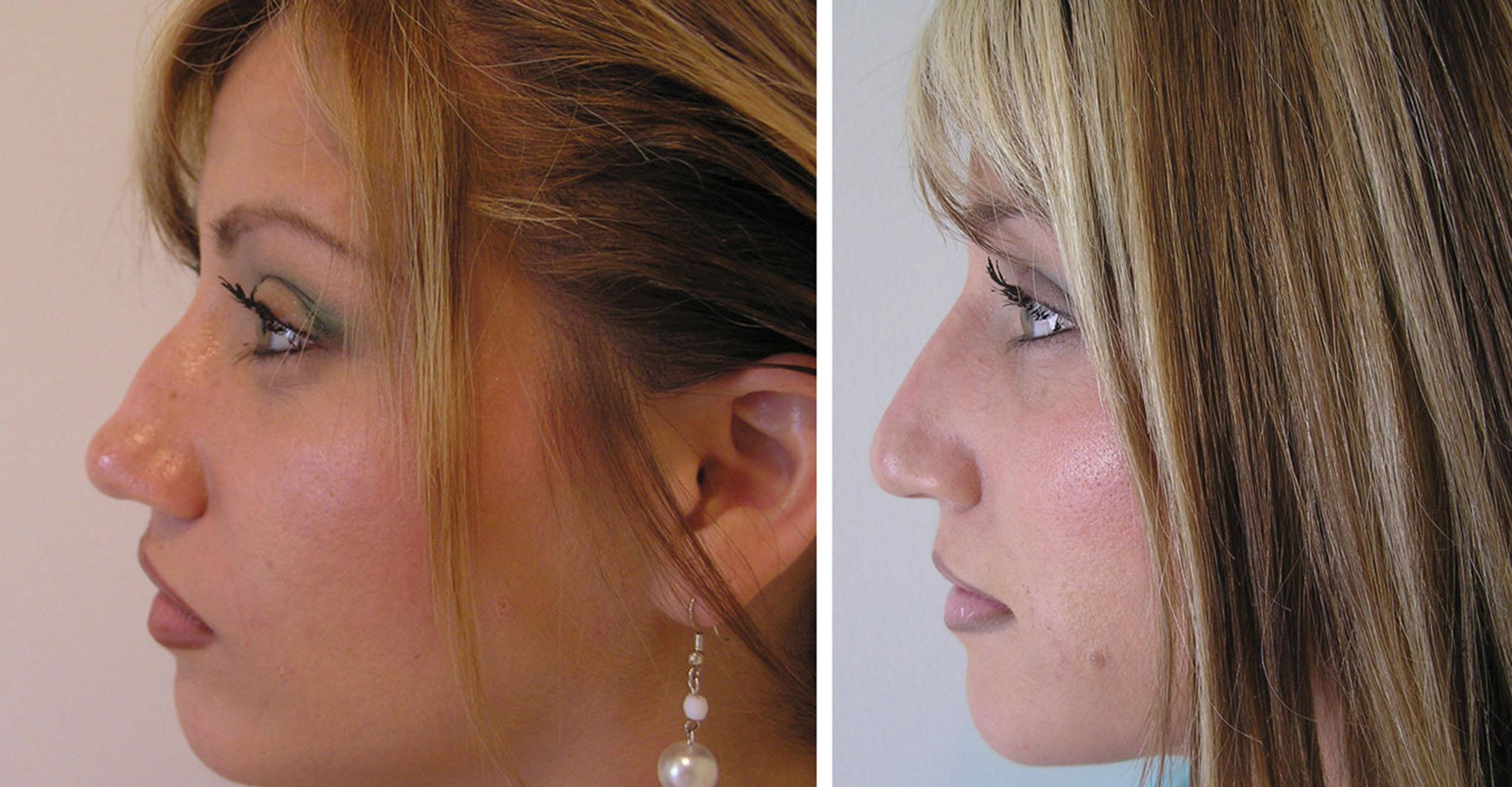 Fig. 10.110, This patient underwent hyaluronic acid nonsurgical rhinoplasty to camouflage a dorsal hump. The patient wanted to use a minimum of product to make her profile straighter. She believed a slight curve would make her nose look more natural.