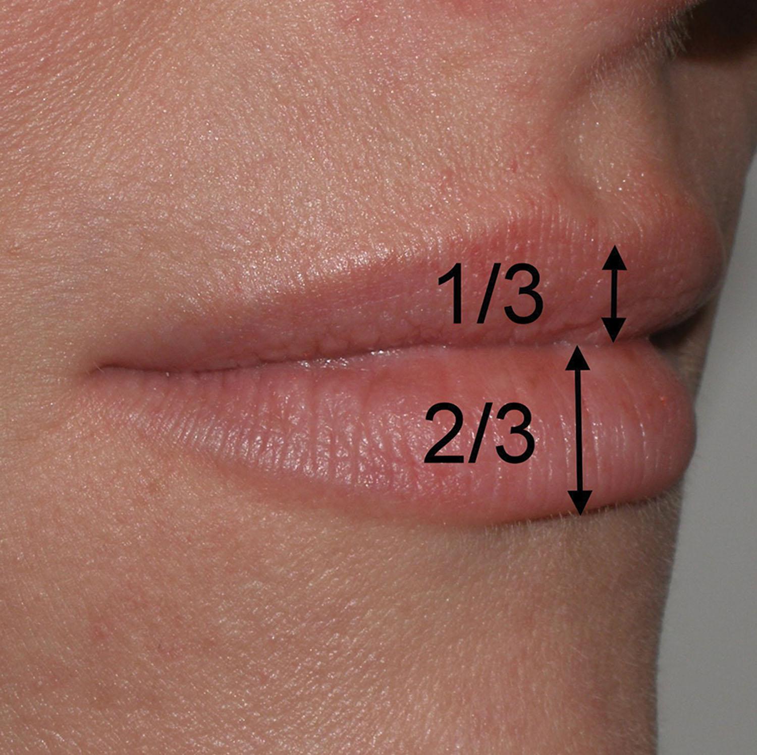 Fig. 10.11, The classical Caucasian lip is frequently discussed as conforming to the Golden ratio in which the upper lip is one-third of the total volume and the lower lip is two-thirds of the total volume. Many injectors feel that current mores and fashion have changed this to more of a 50:50 ratio.