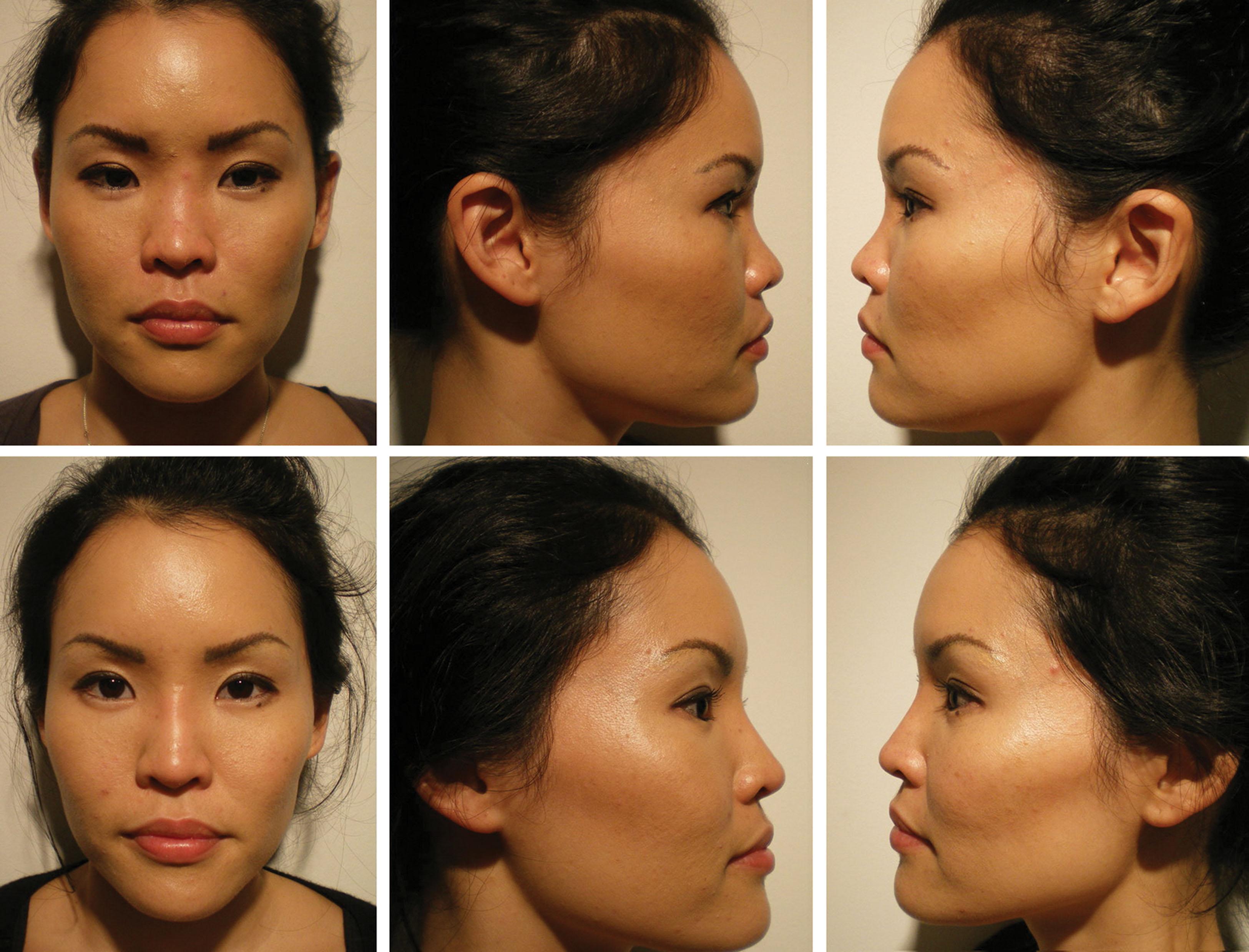 Fig. 10.114, This Asian patient underwent nonsurgical rhinoplasty to augment and better define a nasal bridge and tip.