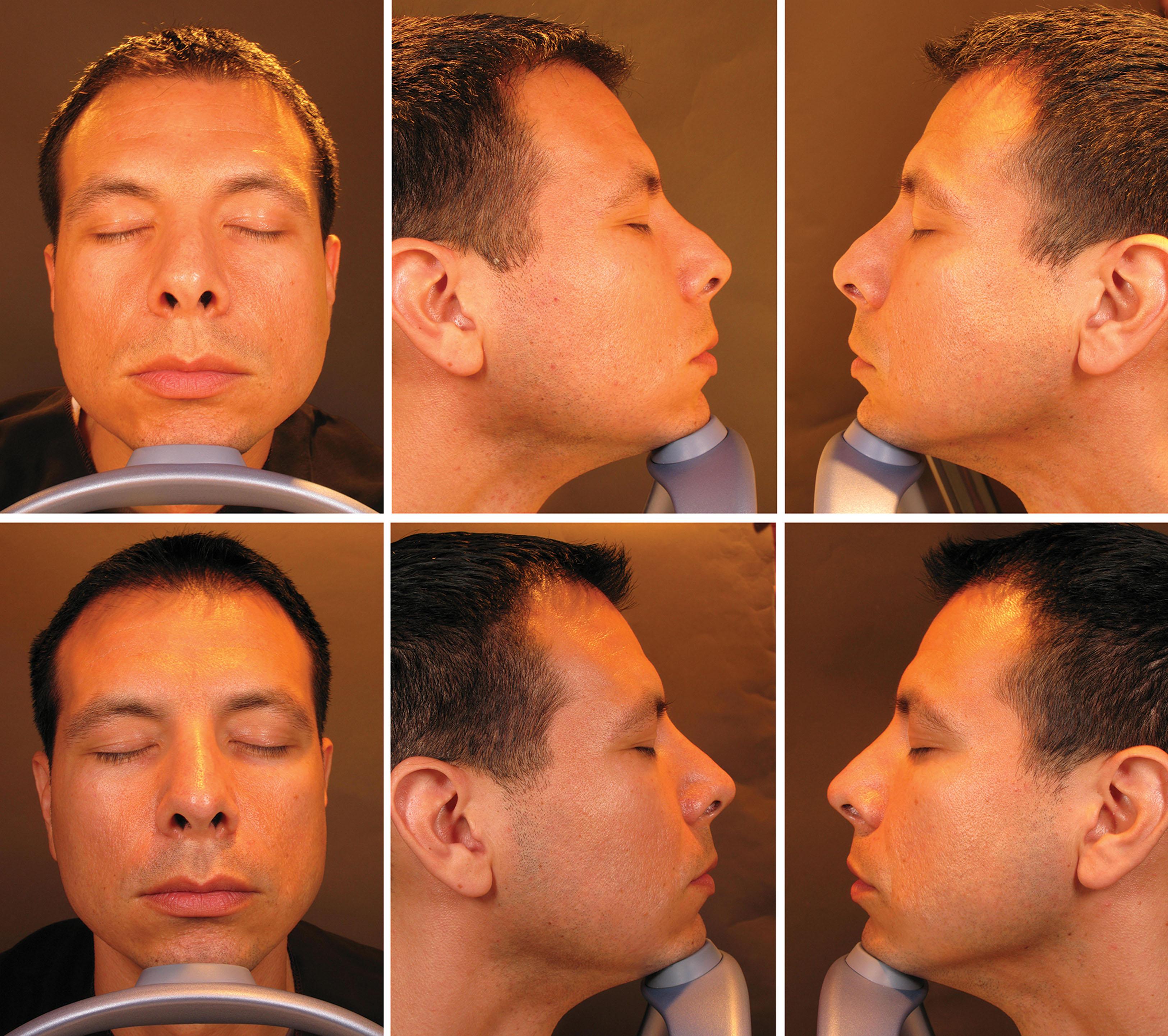 Fig. 10.115, This patient underwent Artefill nonsurgical rhinoplasty to correct postsurgical contour irregularities and asymmetry of the dorsum and to lift the nasal tip. Lower series were taken 1 year after the last of three sessions of Artefill injections.