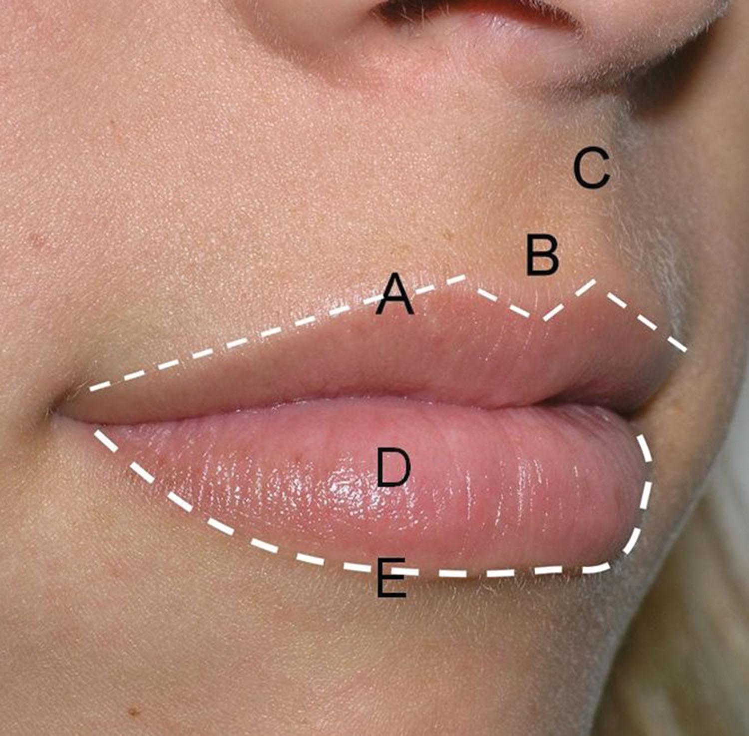 Fig. 10.12, All injectors must have a comprehensive understanding of perioral anatomy to achieve aesthetic results. Some of the more important landmarks (indicated by the white dashed line ) include (A) Cupid’s Bow of the upper lip, (B) philtrum (C) philtral column, (D) lower lip vermilion, and (E) the white roll of the lower lip.