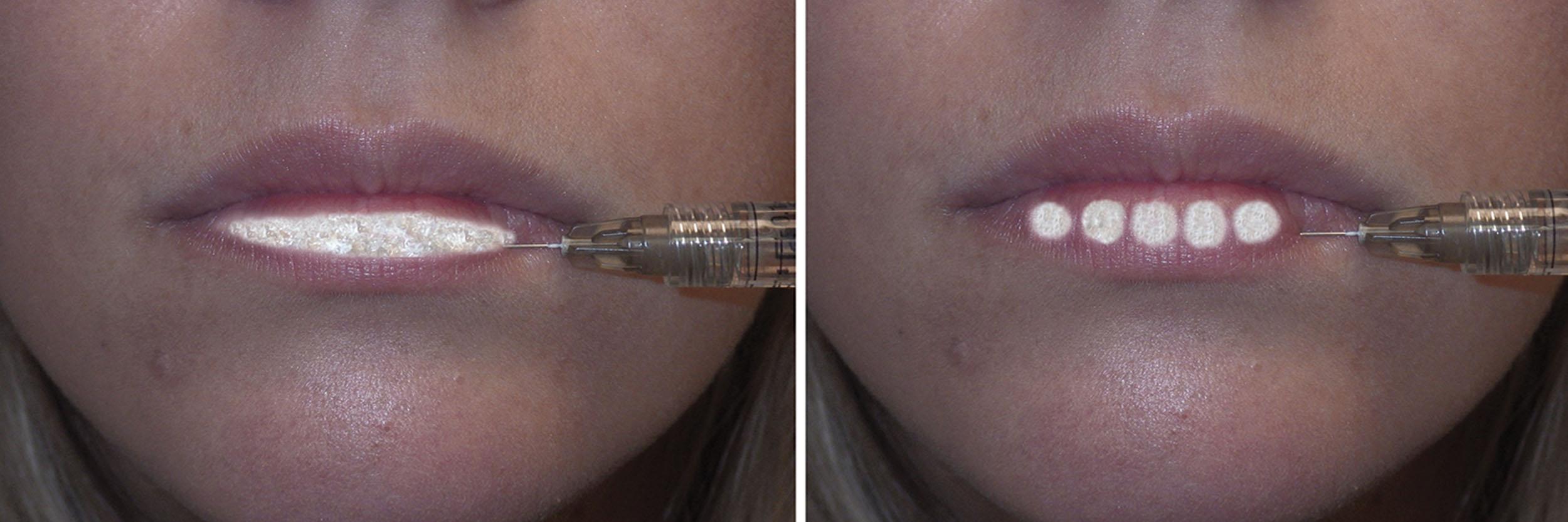 Fig. 10.13, The linear threading technique (left) and serial puncture technique (right) are shown. There is no finite definition for either technique. Most experienced injectors use a combination of these techniques or the pillar technique in which the needle is inserted perpendicular to the lip.