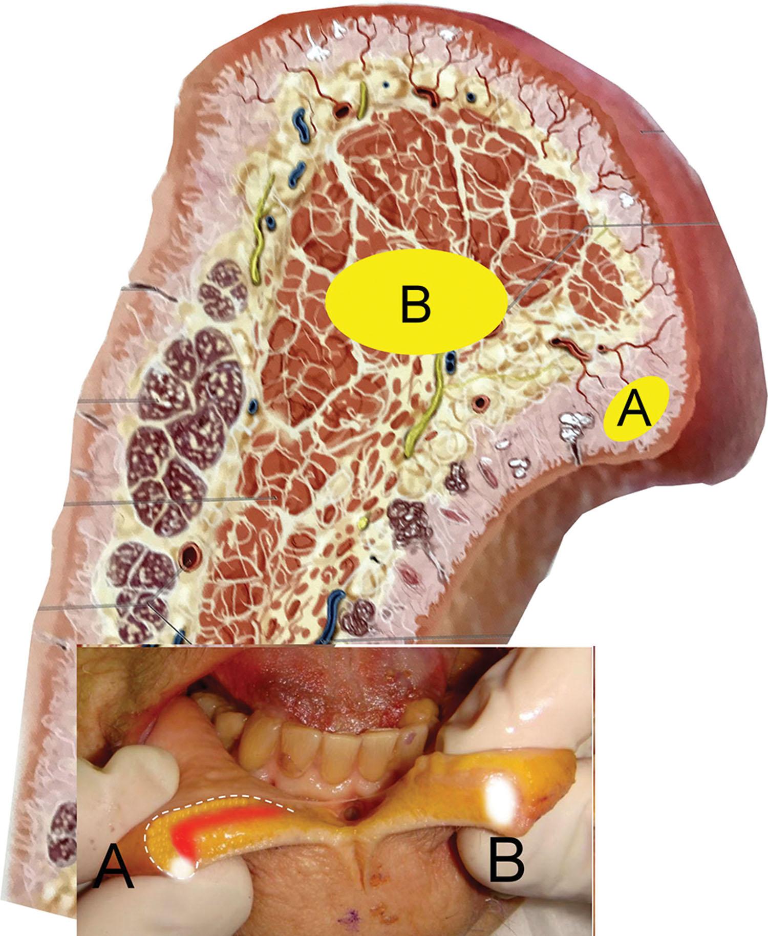 Fig. 10.15, This drawing (and the cadaveric image inset ) shows the target tissues for lip outline versus deep volume increase. For the lip-outlining technique, the filler is injected in the white roll in the potential space that lies between the vermilion/mucosa/skin junction and the underlying muscle (A). When injecting for deep volume or pout, the filler is injected deeper in the central lip tissues (B).