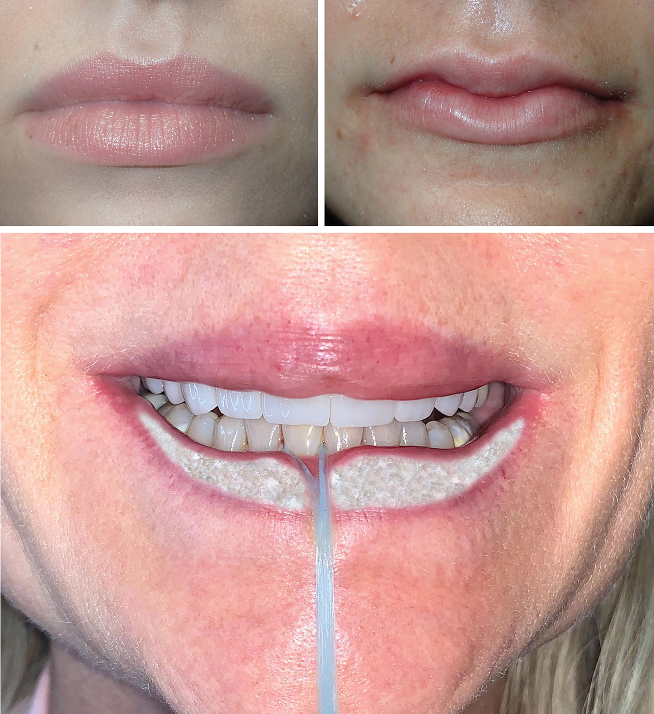 Fig. 10.16, A patient with arcuate upper and lower lips (top left) and a patient with tubercles (top right) are shown. Constructing the tubercular look on an otherwise flat lip can be performed by securing dental floss around a lower central incisor and placing traction on the lower lip to create a midline obstruction. While the patient or assistant holds the dental floss tightly (bottom) , the injector can place the filler on either side to assist in creating “lip cleavage.”