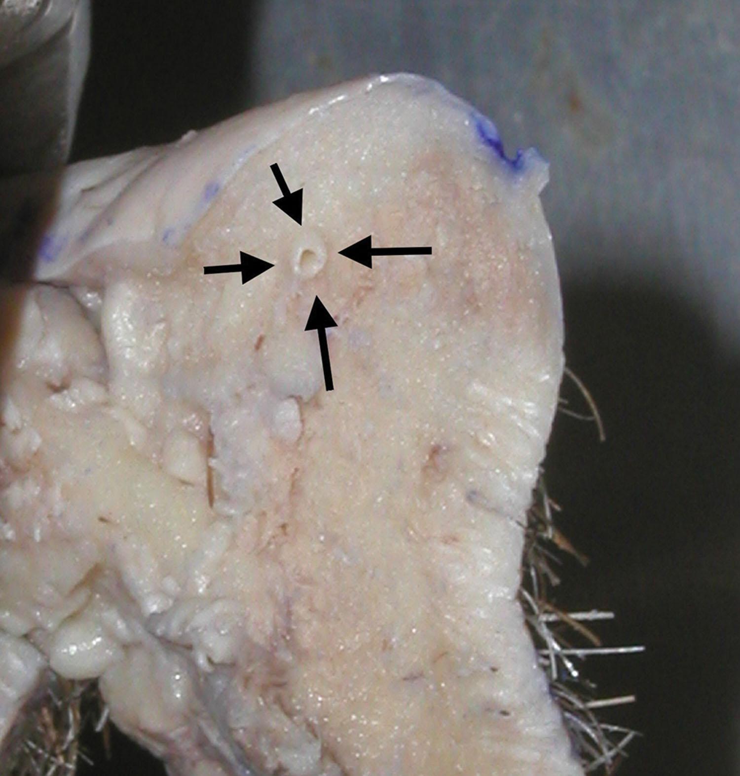 Fig. 10.17, This cadaveric specimen illustrates the posterior position of the labial artery (arrows) in the lower lip. The artery lies more posterior in the lower lip at the approximate height of the lower incisor teeth.