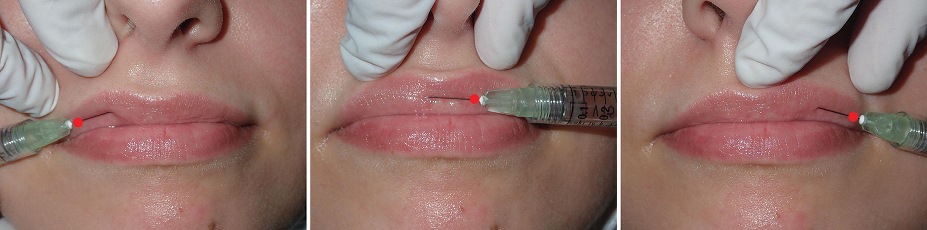 Fig. 10.18, The lips are very vascular, and limiting the number of injection points will reduce the amount of postoperative edema and ecchymosis. Utilizing the full length of the ½-inch needle generally allows the entire lip to be treated with three injection points. The red dots indicate the injection point, and the filler will be released ½ inch distal to the injection points. The injector then injects while withdrawing the needle. The fewer punctures, the better.