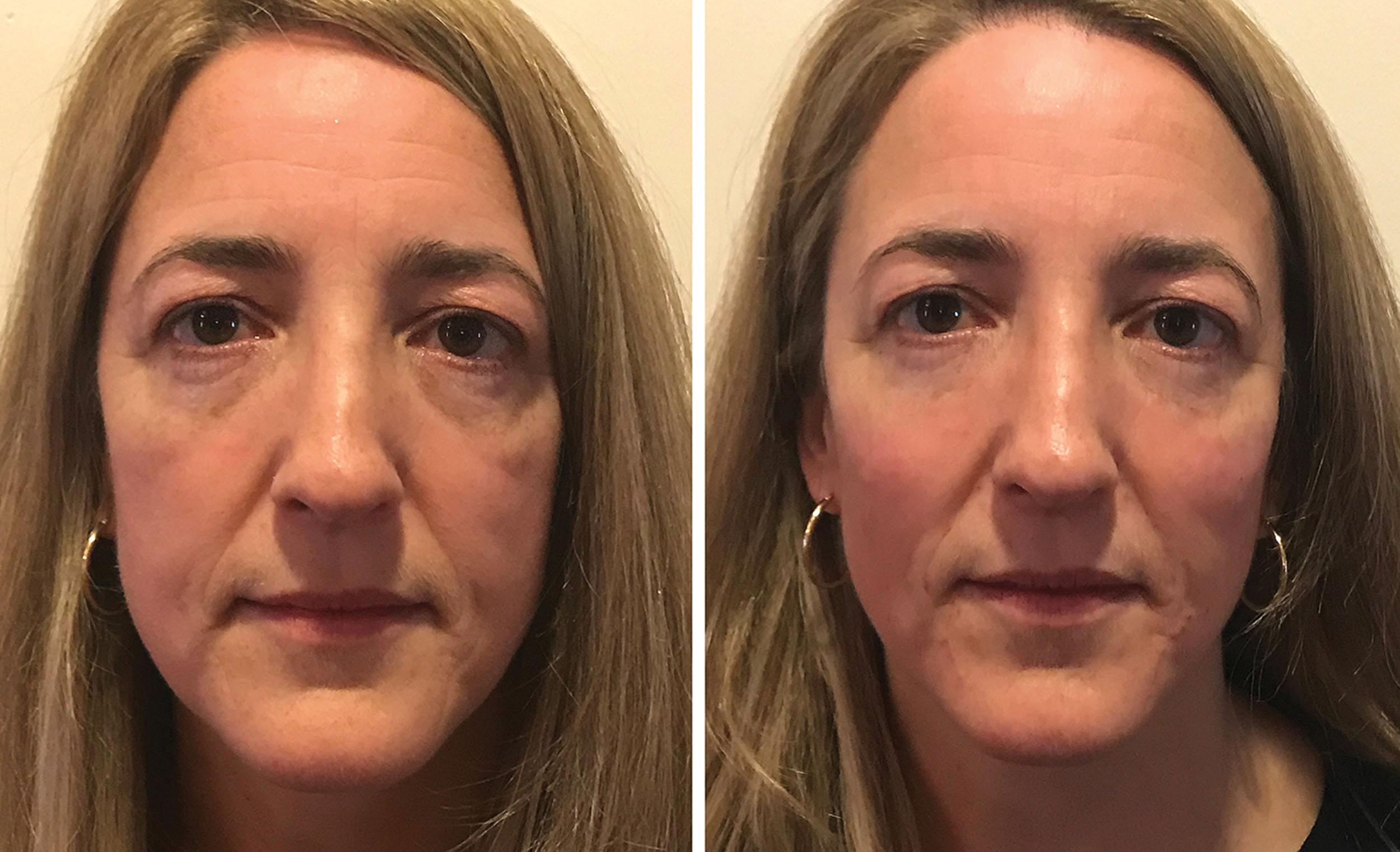 Fig. 10.2, This patient is shown before (left) and five minutes after (right) injections of non–animal-stabilized hyaluronic acid (NASHA)–Restylane-L along the infraorbital rims with a 30-g needle and calcium hydroxylapatite on the midface periosteum with a 27-g cannula.