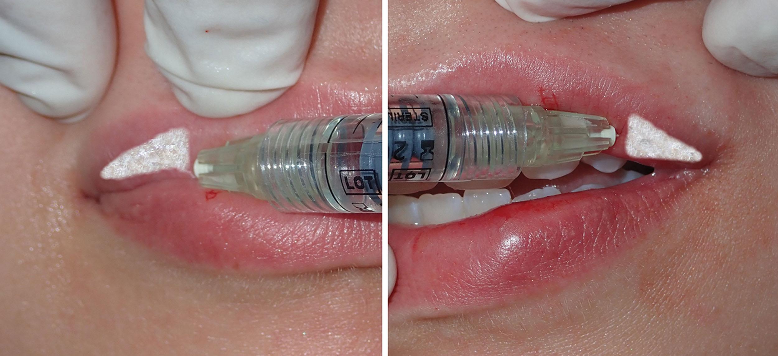 Fig. 10.21, In many cases, no filler is placed all the way to the end of the oral commissures; however, some patients request this, and others may need augmentation in this area. If performed, a tapered injection is done with the needle placed into the commissure, and the filler is injected as the needle is withdrawn.