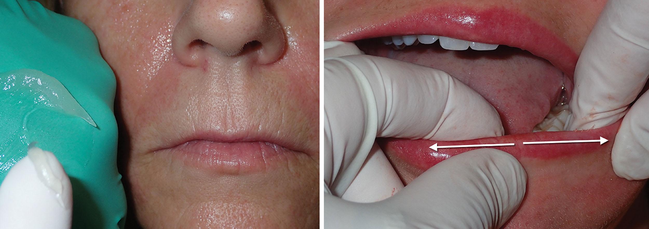 Fig. 10.22, Massage can be a very important part of filler treatment. Even in the best hands, filler can be injected in a manner that produces irregularities that can be seen or felt. By gently lubricating and massaging the lips, these gel fillers are easily homogenized into a smoother and contiguous result. The lip is lubricated with petroleum jelly, and the injected area is gently drawn across the injection area.